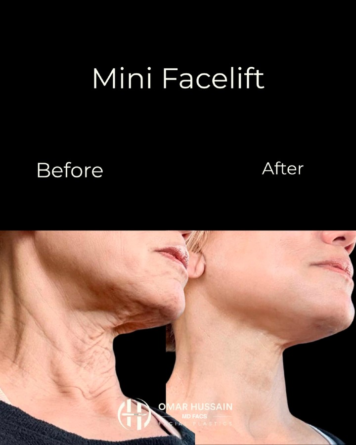 A remarkable transformation with a naturally refreshed result. ✨
This Mini Facelift restored a smoother jawline and a more defined neck contour while preserving the patient's natural appearance. No drastic changes—just a rested, rejuvenated version of herself.
The best facelift is the one that has people saying, "You look amazing," not "What did you have done?"
#MiniFacelift #Facelift #NeckContour #FacialRejuvenation #NaturalResults