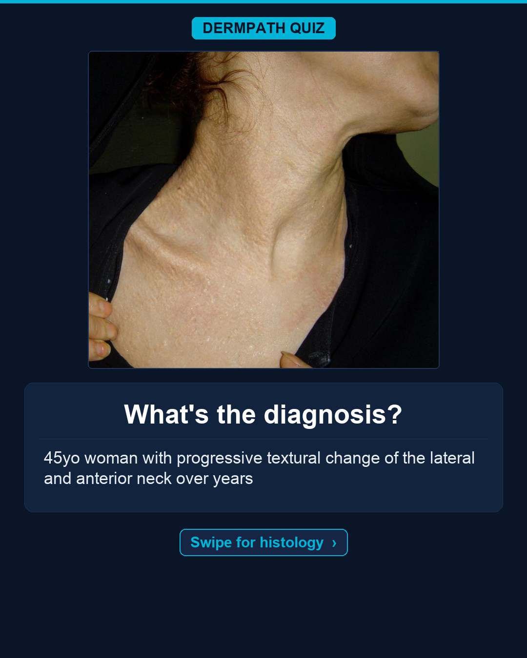 🔬 What's the diagnosis?
The case: 45yo woman with progressive textural change of the lateral and anterior neck over years.
Study the clinical photo and the histology, then make your call. Keep swiping for the diagnosis, the labeled slides, and the high-yield pearls.
Your diagnosis? Drop it in the comments before you swipe to the answer 👇
Save this for board review and tag someone who would nail it. Follow for new dermatopathology cases!