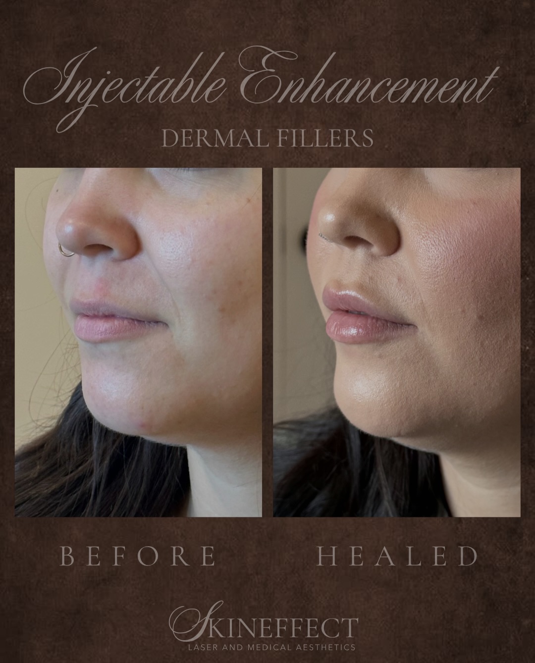 Look at these gorgeous HEALED Lippies! 💋💋💋
The perfect pout ready for summer! ☀️
At SkinEffect, we pride ourselves on posting, healed and natural work. There is no guessing if our injectors are going to make you look “too fake” or not like yourself. We like to make sure that our clients look authenticity themselves just ✨enhanced✨. Which is exactly what was done here!
Save this for your Lip Inspo Pic! 💋
#skineffect #yegmedispa #medicalaethetics #injectables #luxuryaesthetics
•
•
•
{Edmonton Medi Spa • Sherwood Park Medi Spa • Fort Saskatchewan Medi Spa • yeg Medi Spa • yeg • Medical Aesthetics • Medical Aesthetician • Nurse Injector • Chemical Peel • HydraFacial • IPL • Microneedling • PRP • Vampire Facial • Forma • Fillers • Lip Filler • Cheek Filler • Chin Filler • Botox • Dysport • Nucieva • Spray tan • Sherwood park spray tan • Edmonton spray tan • spray tan Artist • NUDA spray tan}