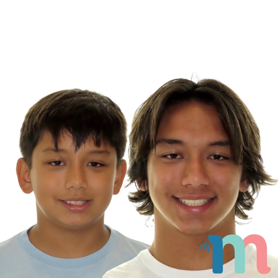 Same smile. New confidence. 😁
Orthodontics isn’t just about straight teeth—it’s about creating healthy, confident smiles that last a lifetime. We love seeing transformations like this! ✨
•
•
📍 Huntington Beach | Orange County | California
☎️ (714) 500-7147
🌎 www.messenger-smiles.com
•
•
•
#SmileJourney #Orthodontist #BeforeAndAfter #HealthySmile #confidence