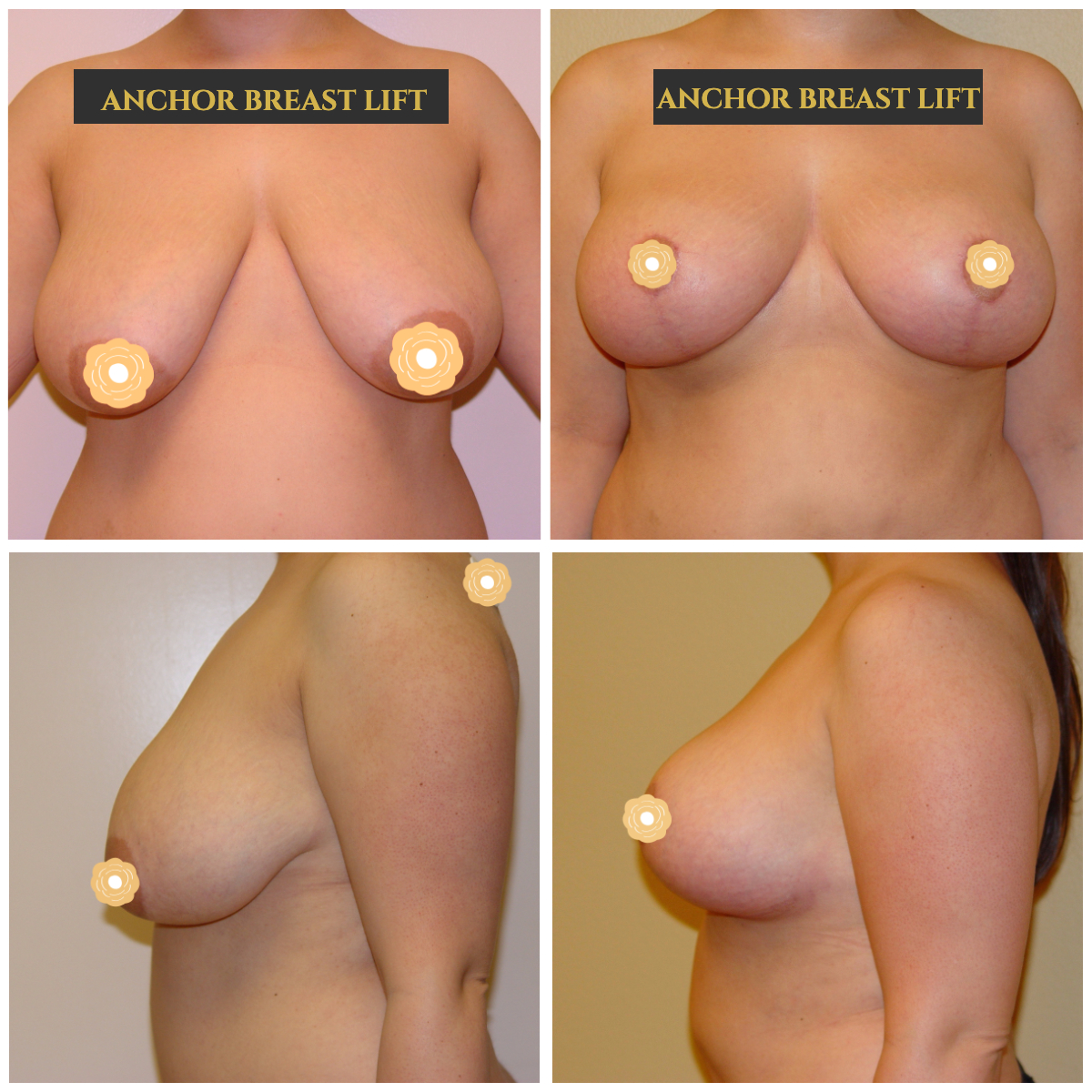 Anchor breast lift on a young 25-year-old woman who has not had children but has very large droopy DD breasts. No implants were put in.