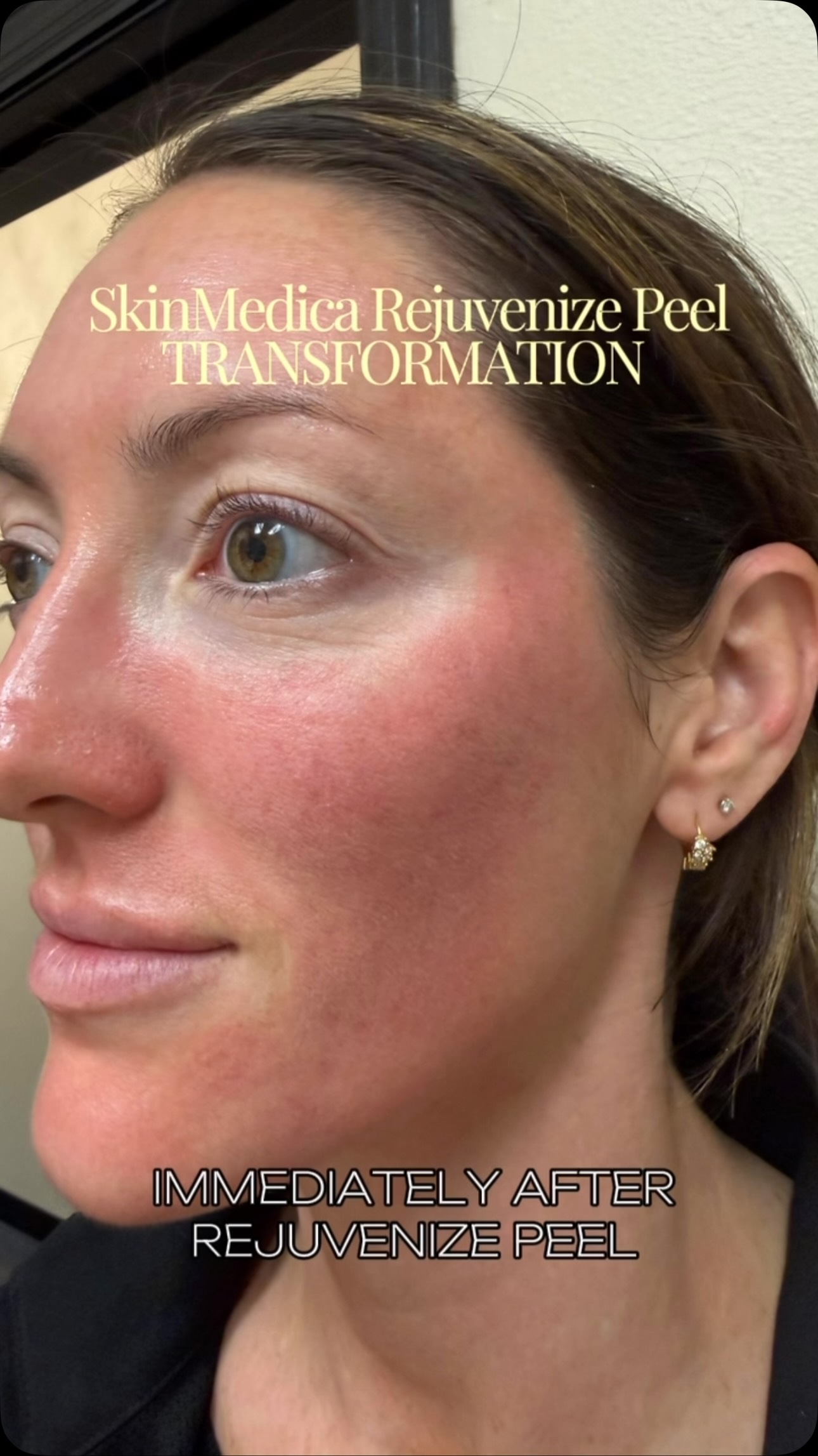 Real skin transformation takes time⌠and trusting the processâ¨
Follow Kaitâs healing journey after the SkinMedica Rejuvenize Peel, an advanced chemical peel designed to target fine lines, pigmentation, uneven texture, acne scarring, and visible sun damage by accelerating skin cell turnover and revealing healthier, brighter skin beneath.
Peeling is part of the process⌠glowing skin is the rewardđ¤
Visible improvement can happen after just one treatment, with best results seen through a series.
Ready to reveal healthier, brighter skin of your own? Call 715.506.2222 to book your peel with our team todayâ¨
#Skinnovations #PeelTranaformation #Wausau #Minocqua #Medspa