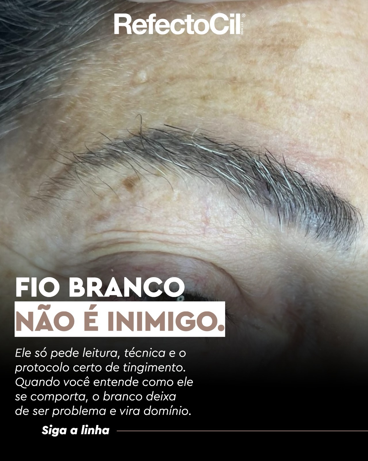 Você já parou pra pensar em como o fio branco muda o seu protocolo de coloração?
Arrasta que a gente te explica tudo.
O fio branco não tem a ver com idade, tem a ver com o folículo: ele para de produzir melanina e o fio nasce sem pigmento, seja por fatores genéticos ou pelo avanço da idade.
Antes do atendimento, no momento da anamnese, por exemplo, vale observar a quantidade, textura e proporção dos fios brancos. Eles costumam ser mais grossos e resistentes, o que muda completamente o comportamento na coloração.
O protocolo certo passa por diversas etapas e tempo de ação da tintura personalizado, para que a escolha de tom não deixe um design marcado e um tom muito escuro ao desejo da cliente.
E o resultado esperado? A coloração pigmenta o fio branco, mas não o elimina, pois ao finalizar o ciclo do crescimento, o fio branco nascerá novamente!
Alinhar isso antes do atendimento evita frustração e fortalece a confiança da cliente no seu trabalho.
Você já leva isso em consideração nos seus atendimentos? 👇
.
.
#refectocilbrasil #theworldinyoureyes #tinturadesobrancelhas #fiobranco #mordacagem
@academiarefectocil @refectocilcolombia, @refectocilperu, @refectocilchile, @refectocilecuador