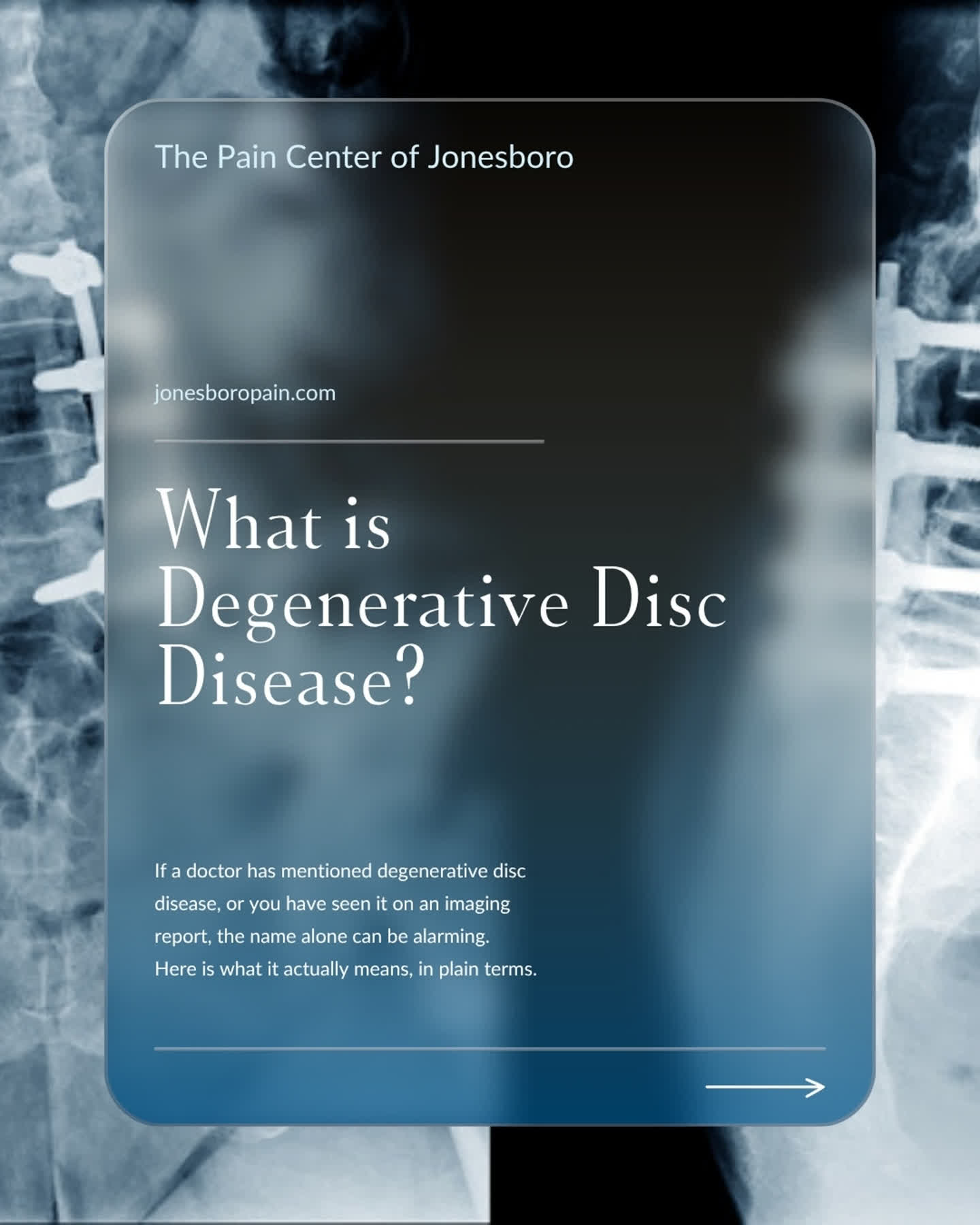 Few diagnoses sound scarier than they are. Degenerative disc disease is one of them.
Despite the name, it is not a disease you catch or that keeps spreading. It describes the natural wear that happens to the discs in your spine over time, and almost everyone experiences some of it as they age.
Swipe through for what it actually means, why it sometimes causes pain, and what can be done about it.
The goal is never just to read the scan. It is to find what is actually causing your pain.
📞 (870) 972-0411
#DegenerativeDiscDisease #BackPain #NeckPain #ChronicPain #PainManagement #JonesboroAR