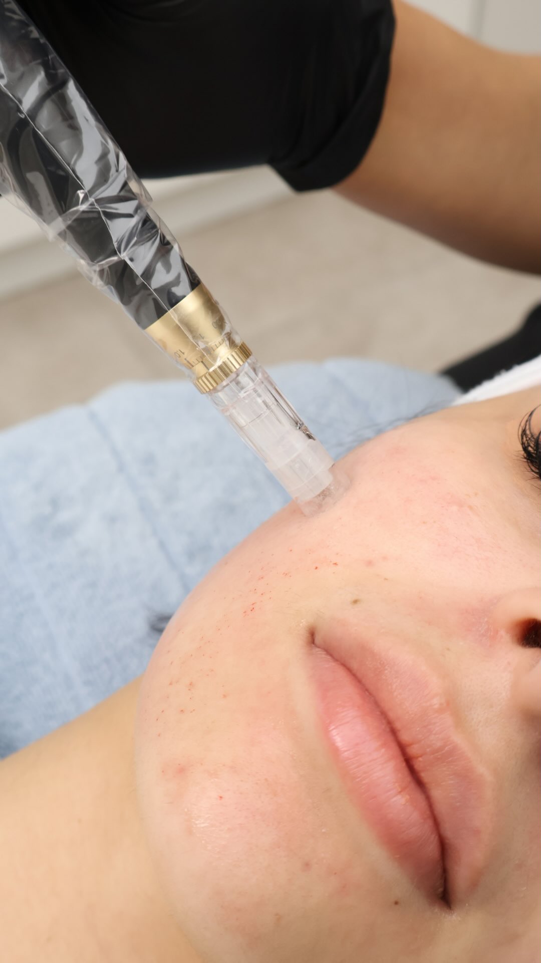 Good skin doesn’t happen overnight, it’s built through consistency, skin health and treatments that support long-term results ✨
Skin Needling is one of those treatments that focuses on improving overall skin quality by supporting your skin’s natural renewal processes.
Whether your focus is texture, post-acne marks, fine lines or simply wanting healthier-looking skin, treatment plans are always tailored to your individual skin goals and concerns.
Sometimes the best results come from investing in your skin slowly, consistently and intentionally, not chasing quick fixes 🤍
Book a consultation to learn more about personalised skin treatment plans at Enhanced by Darcie 🔗
