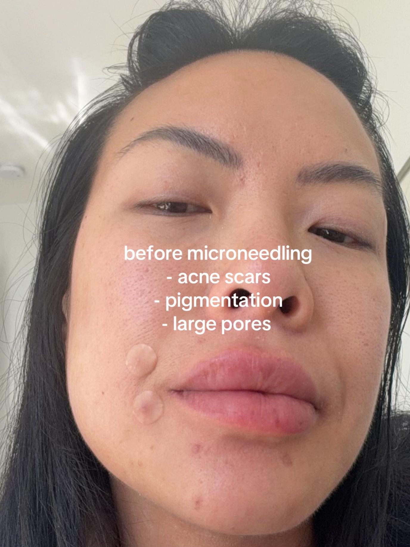 My microneedling journey as someone with eczema and sensitive skin!!
I don’t get eczema on my face but after going through TSW 10 years ago, I’ve always been nervous about doing any kind of skin treatments.
I recently got microneedling done and I’m glad I did! I’ve noticed an improvement in the appearance of my pores and scars
10/10 would do it again 🤍
I’m heading to Korea this week EEEEEE so I’ll be getting the full skincare experience — treatments, skin analysis, and ofc buying aaaalll the skincare 🧴✨🧖🏻♀️
So don’t forget to hit follow for more skincare tips and my skin journey @juliachien.rd
#skincaretreatment #microneedling #eczematreatment #eczemahealing #sensitiveskin