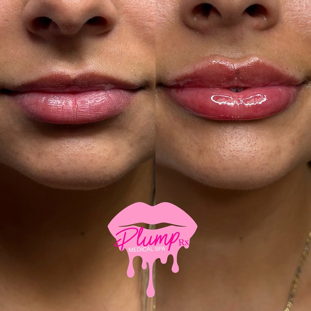 Vertical height was added to give these lips a lifted, fuller, yet beautifully natural appearance โจBy enhancing the height of the lips, not just adding volume, we created better balance, improved shape, and a soft, elegant result that complements the rest of the face โค๏ธ
๐๐๐๐๐ ๐๐ ๐๐๐๐๐๐๐ ๐๐๐
๐ Reading, Ma
๐ฝ๐ ๐ฃ ๐ธ๐ก๐ก๐ ๐๐๐ฅ๐๐๐๐ฅ:
๐ฒ BOOK NOW: Plumprxmedspa.com
๐๐๐ฅ๐ฎ๐ฆ๐ฉ๐ซ๐ฑ@๐ ๐ฆ๐๐ข๐ฅ.๐๐จ๐ฆ
๐ฒ๐ 781-521-0236
#LipFiller #NaturalLipFiller #BostonInjector #LipGoals #MedicalSpa FacialBalancing