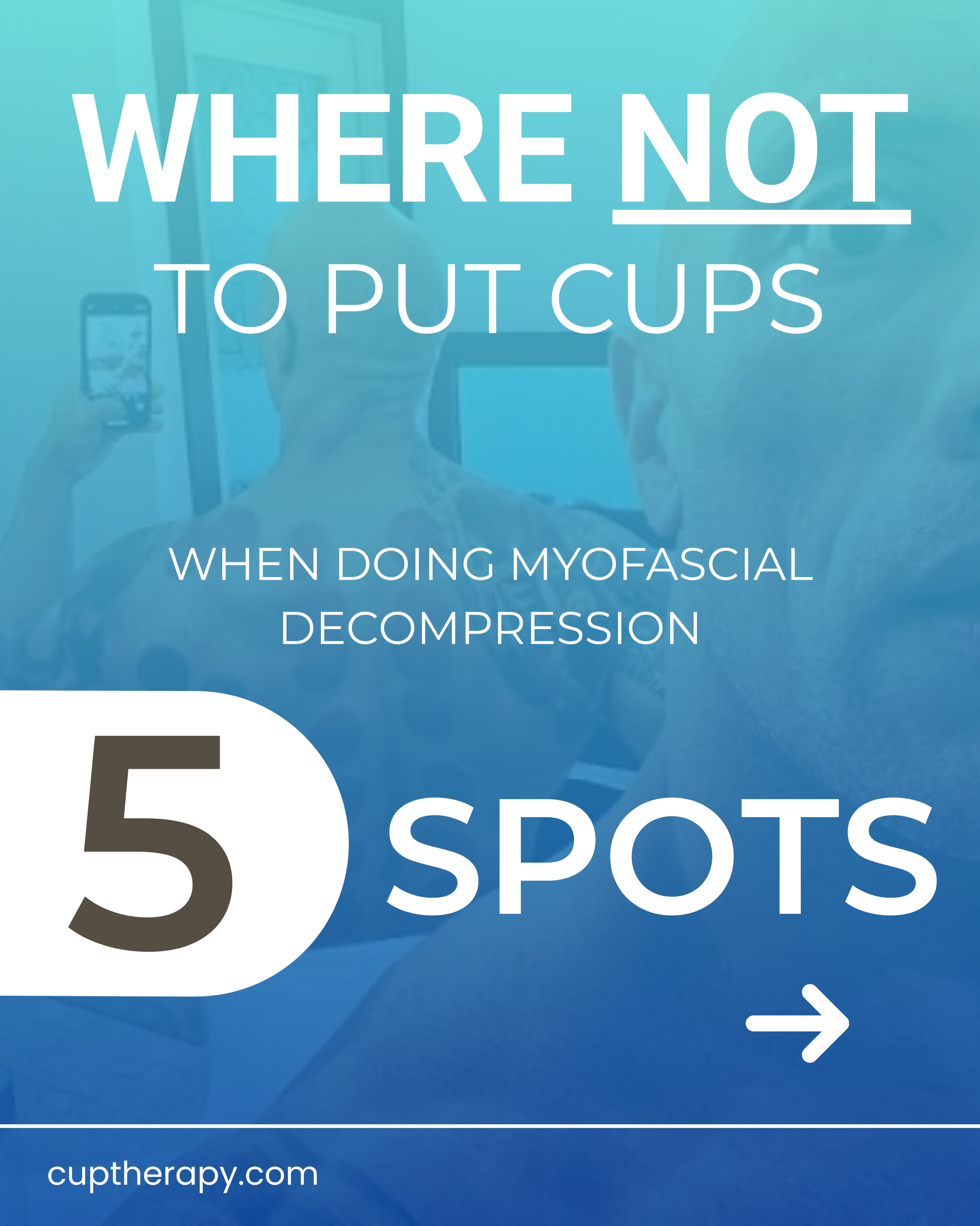 The best practitioners don’t ask, “Can I fit a cup here where they are tight?” They ask, “Should I put a cup here, and what is my clinical rationale?” Cupping is not just about creating a mark—it’s about understanding tissue response, anatomy, physiology, contraindications, and risk management. Safe practice requires more than technique; it requires clinical reasoning grounded in current evidence.
⭕️
Five areas that deserve extra caution—or are generally places you don’t want to be applying cups:
👀 Eyeballs – The eye is a delicate, pressurized structure. Negative pressure and ocular tissues are not a good combination.
🎯 Nipples and areolar tissue – Highly sensitive tissue with unique vascular and neural anatomy. There are much better treatment targets.
🦇 Axilary region – Rich neurovascular structures, sensitive tissues, lymph nodes, and significant risk. Unless it is post radiation cording or a burn it’s a no go zone.
🫁 Anterior neck – Home to the carotid arteries, jugular veins, trachea, thyroid gland, and important neurological structures. This is not the place for aggressive suction.
🦵 Anterior groin/femoral triangle – Contains the femoral artery, femoral vein, lymphatic structures, and nerves. Understanding what’s beneath the skin matters.
⭕️
#cuptherapybluebox
Just because a cup can stick somewhere doesn’t mean it should.