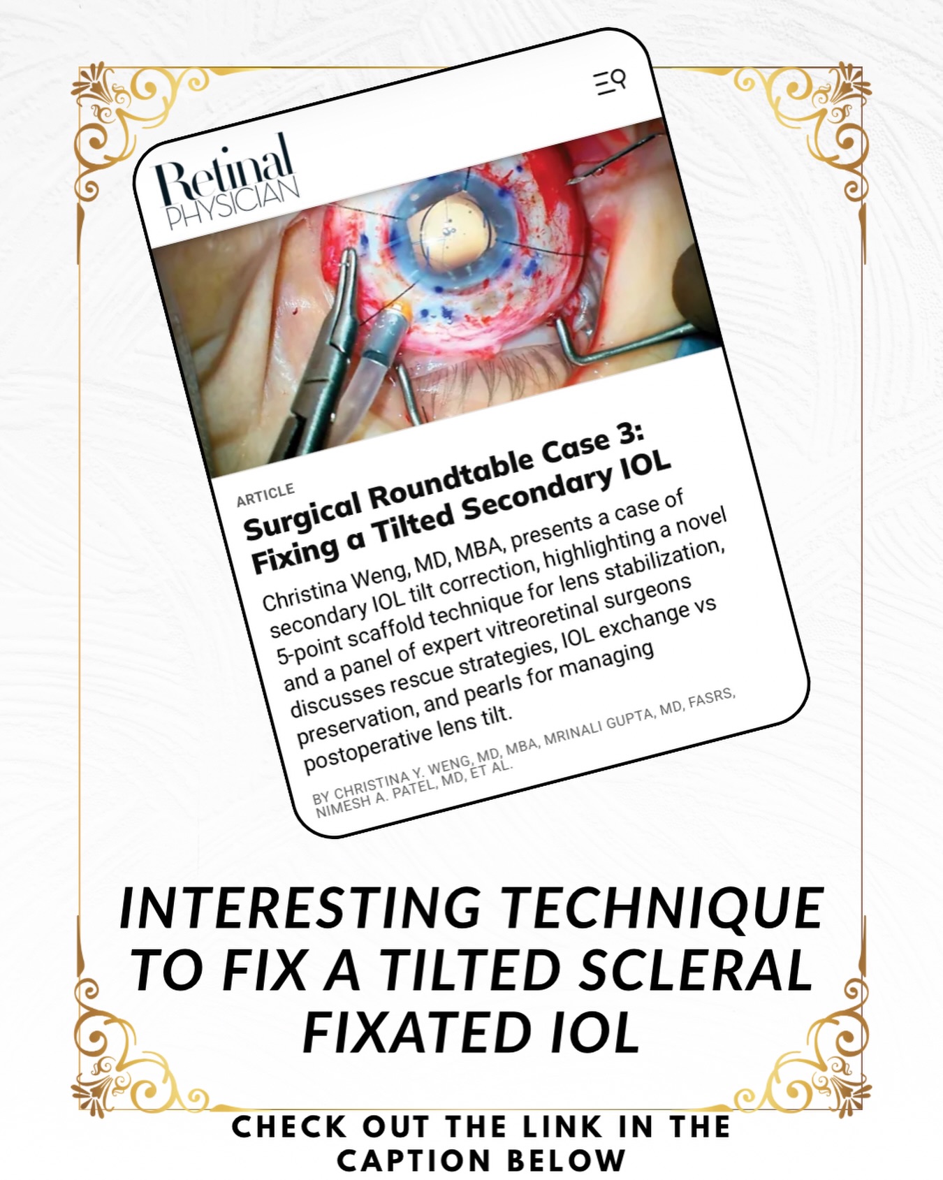 An interesting way to fix a tilted scleral haptic fixated intraocular lens (IOL) without removing it and putting a new one in. This technique uses a 9-0 prolene to form a scaffold behind the IOL so that it stops it from tilting. Same technique that we use to keep silicone oil in the vitreous cavity for aphakic eyes (i.e. silicone oil retention sutures).
View the discussion and video at:
https://www.retinalphysician.com/issues/2026/july-august/roundtable-case-3/
#ophthalmology #intraocularlens #eyesurgery #retinalphysician #eyedoctorchng