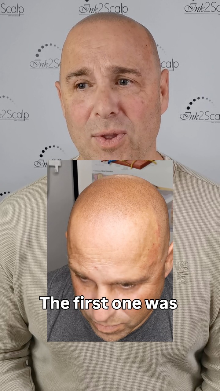 “Amazing!!!” Is the word we love to hear… during and after our clients SMP journey.
It’s says A LOT when your client drives 5 hours away from Montreal 🇨🇦 for his 3 sessions…. We don’t take those efforts for granted.
Welcome to the Ink2scalp Family!!
❤️Ask yourself……. “If you could change it, would you?”
… message for your FREE consultation & your pricing!!
🏆2024 BEST SMP ARTIST (silver🥈) for ALL of 🇨🇦&🇺🇸
🏆2022 WINNER🥇- Best Alopecia (UK 🇬🇧)
🥇2021 Consumer Choice Awards- BEST HAIR RESTORATION
Over 500+ 5 ⭐️⭐️⭐️⭐️⭐️ Google Reviews✅
Scalp Micropigmentation is the 🌎worlds No.1 most natural & non-invasive solution for hair loss
👉Consultations are always FREE 👌and we take all the time you need to chat!
🏆 Ink2Scalp SMP Studios
www.ink2scalp.com/best-smp-studio
647-424-1186
🇨🇦 #naturalsmp #thinksmp #bestsmptoronto #micropigmentation #scalppigmentationtattoo