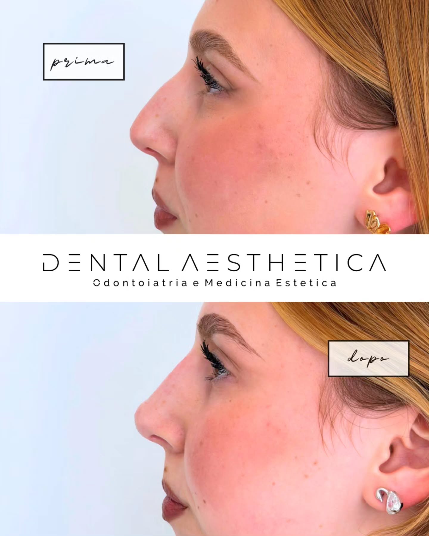 Rinofiller.
🖊 Signature
@dr.silvia.ciarrocchi
🏠Home
@dental_aesthetica_roma
Dental Aesthetica
✨️Odontoiatria e Medicina Estetica
📍viale della Grande Muraglia 256, zona EUR-Torrino
📱3758847069
#rinofiller #rinofillerroma
#fillerroma #medicinaestetica
