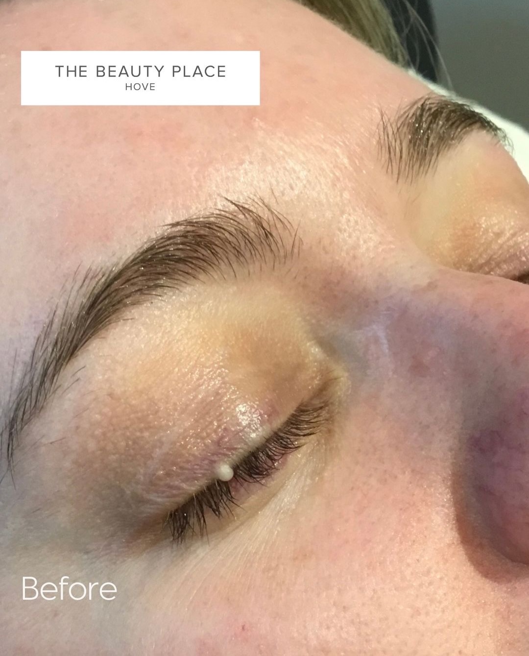Those small white bumps that just won’t disappear? They may be milia.
While they can be tempting to squeeze or pick, removing them incorrectly can damage the skin and increase the risk of scarring. Professional milia removal is a precise treatment that should always be carried out with care and the correct technique.
Swipe to see this beautiful before and after.
At The Beauty Place, every treatment is performed with precision, hygiene, and your skin’s long-term health in mind. Our focus isn’t just on achieving immediate results, but on treating your skin safely and professionally.
If you’re struggling with stubborn milia, we’d be delighted to advise whether this treatment is suitable for you.
Call us on 01273 770880 or email us at info@thebeautyplacehove.com to book your Milia consultation.
#miliaremoval #skin #thebeautyplacehove #brighton #skincare