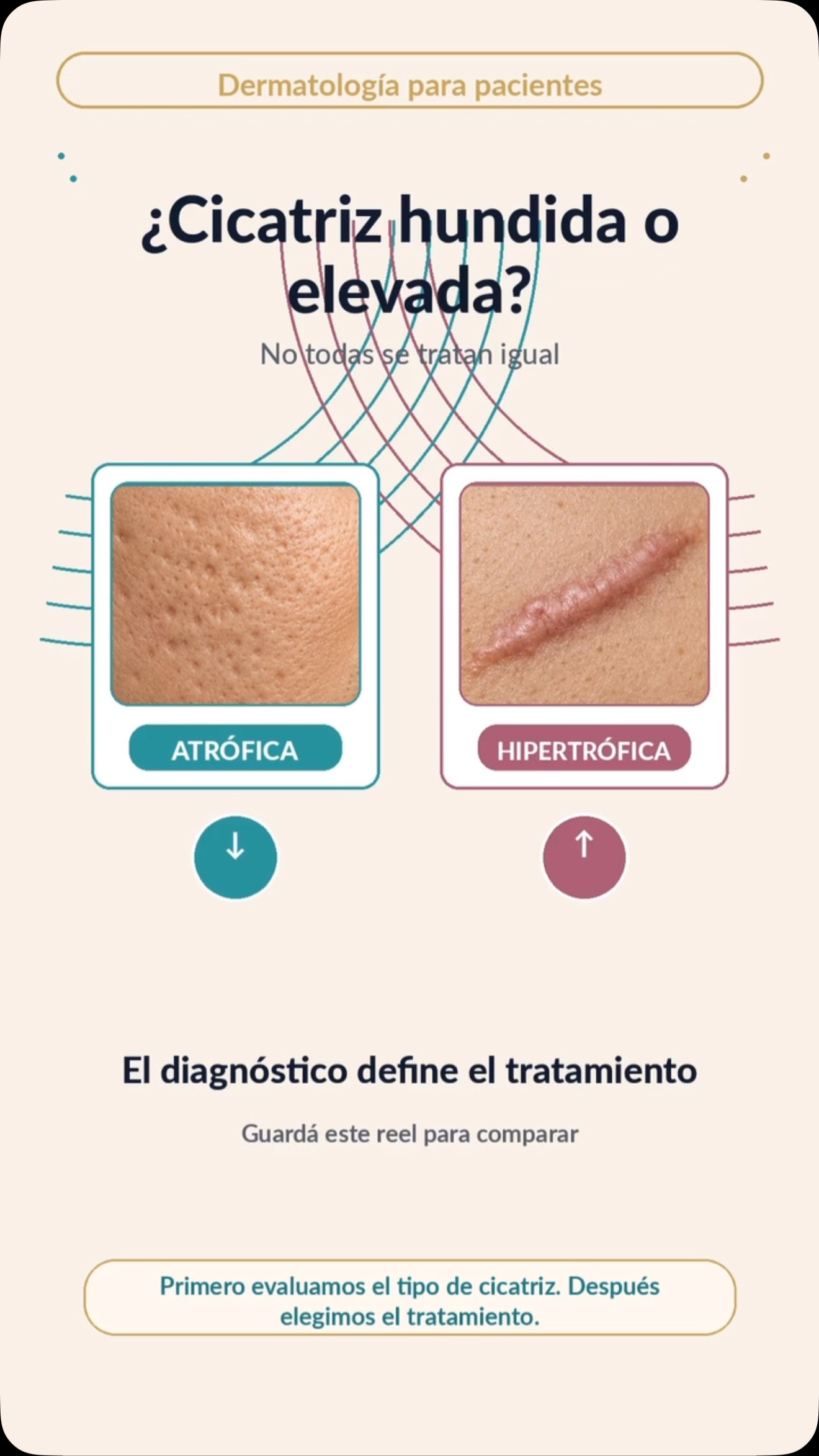 ✨ No todas las cicatrices se tratan igual ✨
Por eso, antes de elegir un tratamiento, lo más importante es saber qué tipo de cicatriz tenés.
🔻 Cicatrices atróficas
Son las que se ven hundidas o deprimidas, muy frecuentes después del acné o la varicela.
El objetivo del tratamiento es estimular colágeno, mejorar la textura y recuperar volumen.
✅ Tratamientos posibles:
• Láser CO₂ fraccionado
• Microneedling / radiofrecuencia
• Subcisión
• Peelings médicos
• TCA CROSS en cicatrices puntiformes
• Rellenos o bioestimuladores en casos seleccionados
🔺 Cicatrices hipertróficas
Son las que se ven elevadas, engrosadas o rojizas, y pueden aparecer después de heridas, cirugías, quemaduras o piercings.
El objetivo es desinflamar, aplanar y mejorar el color y la textura.
✅ Tratamientos posibles:
• Infiltraciones con corticoides
• Láser vascular / IPL para el enrojecimiento
• Láser CO₂ en casos seleccionados
• Siliconas en gel o parches
• Crioterapia
• Combinaciones médicas según evolución
💡 La clave: muchas veces el mejor resultado se logra combinando tratamientos y adaptándolos a cada paciente.
📲 Si tenés una cicatriz que te molesta, consultá para evaluar cuál es la mejor opción para tu piel.
Turnos por WhatsApp: 11 6666-2866
#Cicatrices #CicatricesDeAcne #Dermatologia #LaserCO2 #CuidadoDeLaPiel Acne CicatricesHipertróficas CicatricesAtróficas Dermatologa MedicinaEstetica