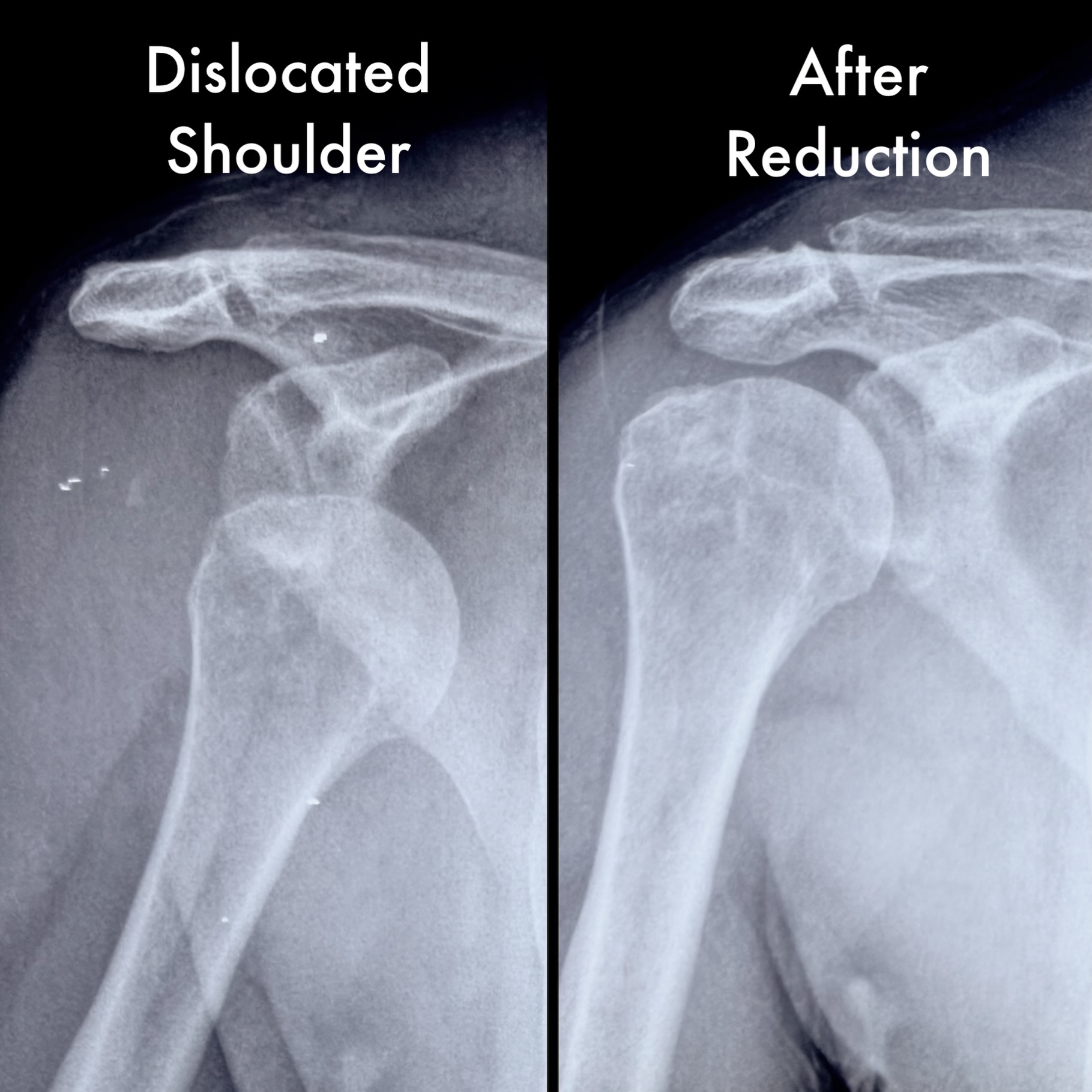 Shoulder Dislocation : Key Facts
👉🏼 Shoulder dislocation is when the ball of the shoulder comes out of its socket completely.
👉🏼 It can occur after a fall, road traffic accident or even during a contact sport
👉🏼 Symptoms include:
• Severe shoulder pain
• Visible deformity
• Inability to move the arm
• Swelling
👉🏼 Urgent care:
Visiting an orthopedic surgeon as soon as possible to get it reduced back into the socket.
Longer the time since dislocation, more difficult it is to reduce without anaesthesia.
👉🏼 When a dislocation happens, it tears off a protective rim around the socket (labrum), called as a ‘Bankart Tear’.
👉🏼 Every successive dislocation erodes the bony socket, ball & makes the shoulder more unstable.
👉🏼 Seeking early treatment and supervised rehabilitation are essential to restore strength and prevent future episodes.
👉🏼 While most of the first-time dislocations can be managed without a surgery, recurrent dislocations require a minimally invasive arthroscopic repair of the Bankart tear.
Want to know further? Visit: https://www.arthrosports.in/post/shoulder-dislocation
#shoulder #shoulderdislocation #shoulderarthroscopy #bankarttear #arthrosports