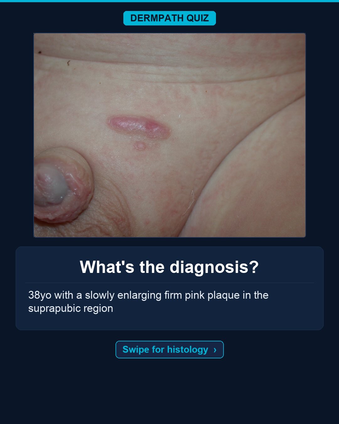 🔬 What’s the diagnosis?
The case: 38yo with a slowly enlarging pink plaque in the suprapubic region.
Study the clinical photo and the histology, then make your call. Keep swiping for the diagnosis, the labeled slides, and the high-yield pearls.
Your diagnosis? Drop it in the comments before you swipe to the answer 👇
Save this for board review and tag someone who would nail it. Follow for a new dermatopathology case every day.