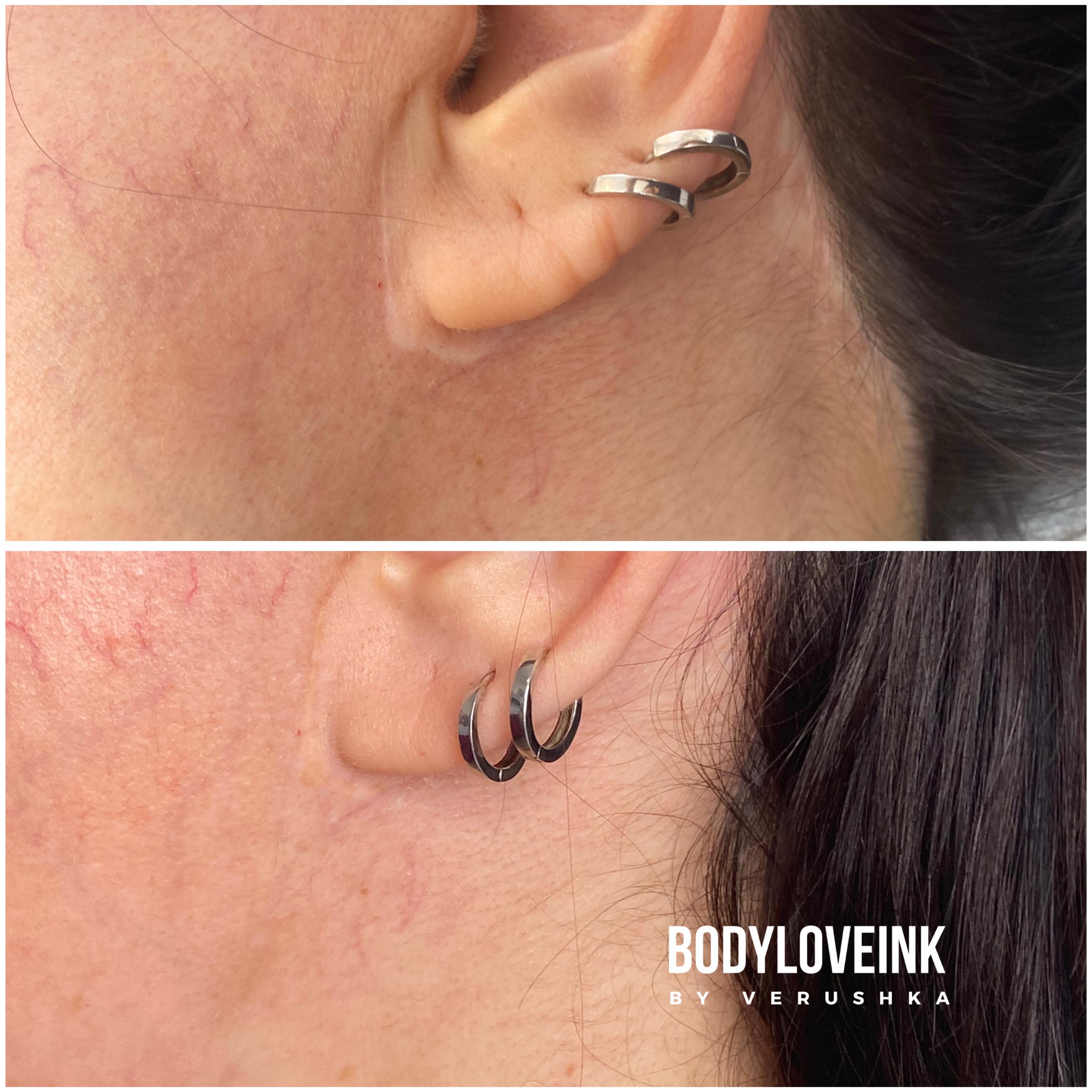 Update: under ear lobe and at hairline are doing well after one session which is a nice reward while we work on improving other scars.
If you have similar scars that you’d like to blend with camouflage pigment please book a consultation.
#scarcamouflage #faceliftsurgery #deepplanefacelift #torontoplasticsurgery #cosmeticsurgery
