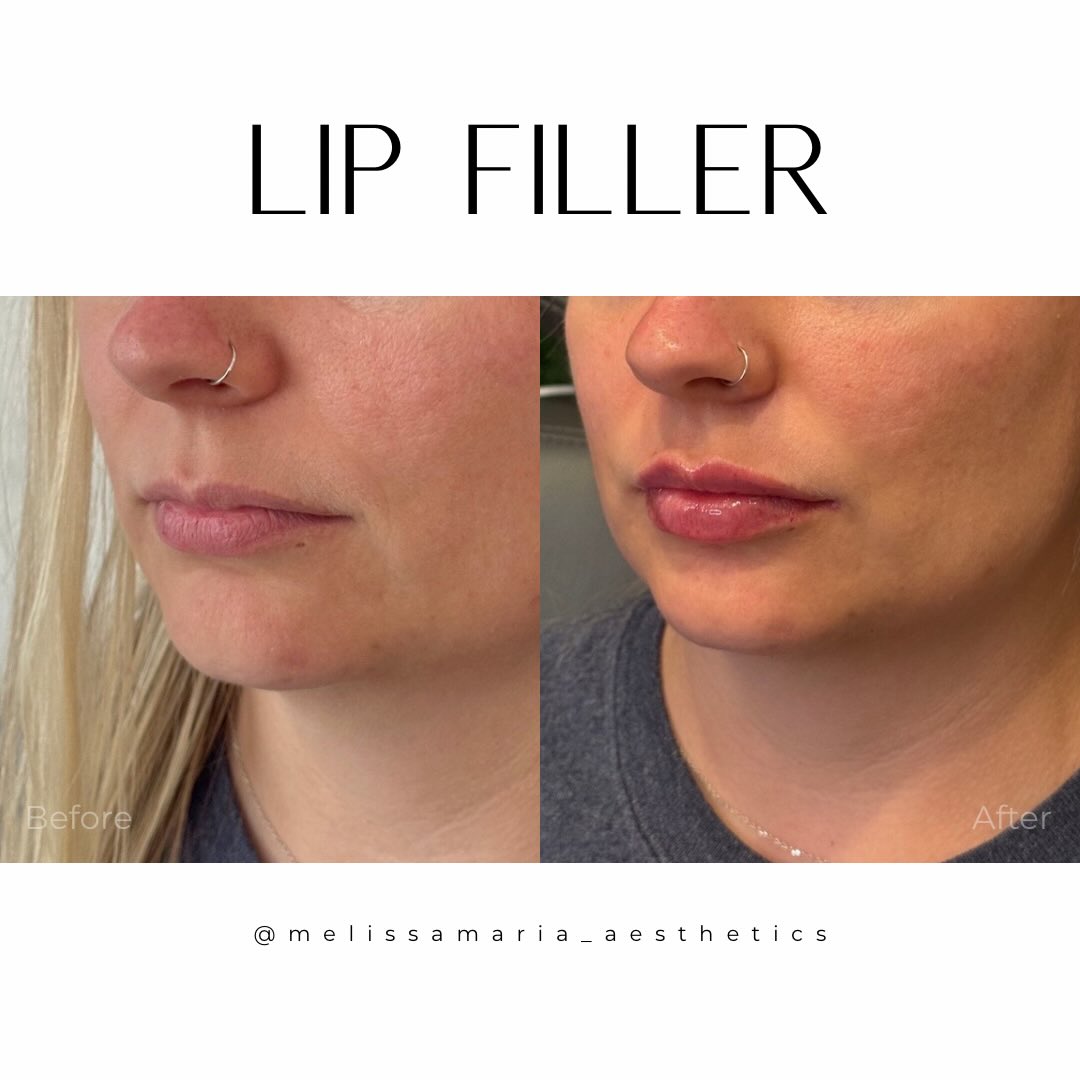 She you just want a little pick me up but you’re scared of significant volume! We can do that. Clean borders, hydrated and natural ✨
#lipsbymeli #lipfillerraleigh #lipfillercharlotte