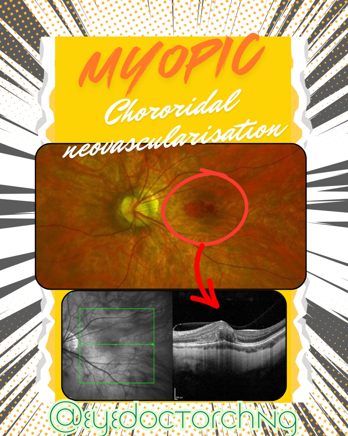 Myopic choroidal neovascularisation (CNV) is the growth of abnormal blood vessels from the choroid into the retina in people with high myopia (severe nearsightedness). It’s the most common cause of CNV in people under 50 years old.
People with pathologic myopia (≥ -6.0 diopters) have 5-10% chance of developing myopic CNV. 35% develop it in the fellow eye within 8 years.
Without treatment, 89% of patients experience marked visual impairment within 5 years due to scarring and macular atrophy.
Warning signs includes:
• Sudden loss of central vision
• Metamorphopsia (distorted vision)
• Blurred central vision
Treatment:
Anti-VEGF therapy is the first-line treatment. Examples include ranibizumab (Lucentis), bevacizumab (Avastin) and aflibercept (Eylea) which are highly effective when started early.
Further treatment info for ophthalmologists:
• Ranibizumab 0.5 mg (Lucentis) - only FDA-approved agent for myopic CNV
• Bevacizumab 1.25 mg - off-label, widely used
• Aflibercept 2.0 mg - off-label
• 1 + PRN (Recommended) - Single loading dose followed by PRN retreatment - achieves comparable visual outcomes to 3 + PRN
• +10.5 to +14.4 ETDRS letters at 12 months
• Approximately 2-line improvement
• 64-66% achieve CNV leakage resolution
• Ranibizumab vs Bevacizumab: No significant difference
• Aflibercept vs Bevacizumab: Similar efficacy, potentially fewer injections
• Better outcomes: Younger age, smaller lesion size, early treatment or better baseline BCVA
• Worse outcomes: Chorioretinal atrophy or advanced myopic maculopathy
• 26% recurrence rate at 12 months
• Eyes requiring ≥3 injections in first episode: 45% recurrence risk
• Recurrence does not adversely affect final visual outcome if treated promptly
#MyopicCNV #Ophthalmology #retina #myopia #eyesdoctorchng