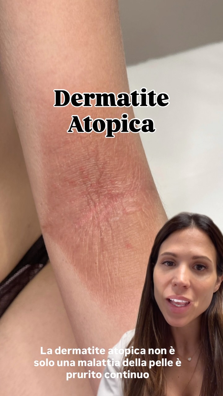 ✨ La dermatite atopica non è “solo pelle secca”. Può causare prurito intenso, infiammazione e avere un impatto importante sulla qualità della vita.
💡 La buona notizia? Oggi esistono trattamenti sempre più mirati che permettono di controllare la malattia e ridurre le riacutizzazioni.
👇 Dimmi nei commenti:
❓ Qual è il sintomo che ti dà più fastidio?
🔹 Prurito
🔹 Rossore
🔹 Pelle secca
🔹 Disturbi del sonno
Oppure scrivi la tua esperienza: potresti aiutare qualcuno che sta vivendo la stessa situazione. ❤️
📌 Salva questo reel per rivederlo quando ne avrai bisogno e condividilo con chi soffre di dermatite atopica.
⚠️ Ricorda: ogni caso è diverso. Una valutazione dermatologica è fondamentale per individuare il percorso terapeutico più adatto.
#DermatiteAtopica #Dermatologo #PelleSensibile