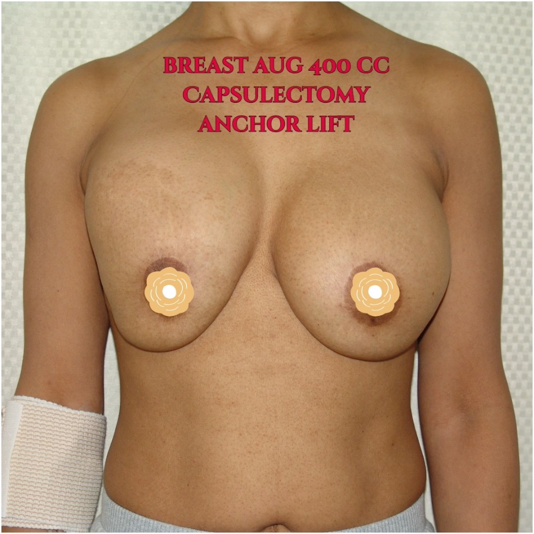 This patient has capsular contracture of the right breast. I removed the capsules from both breasts and changed out her implants from 500 cc to 400 cc to go smaller. I also performed anchor breast left. She now loves her new breasts.