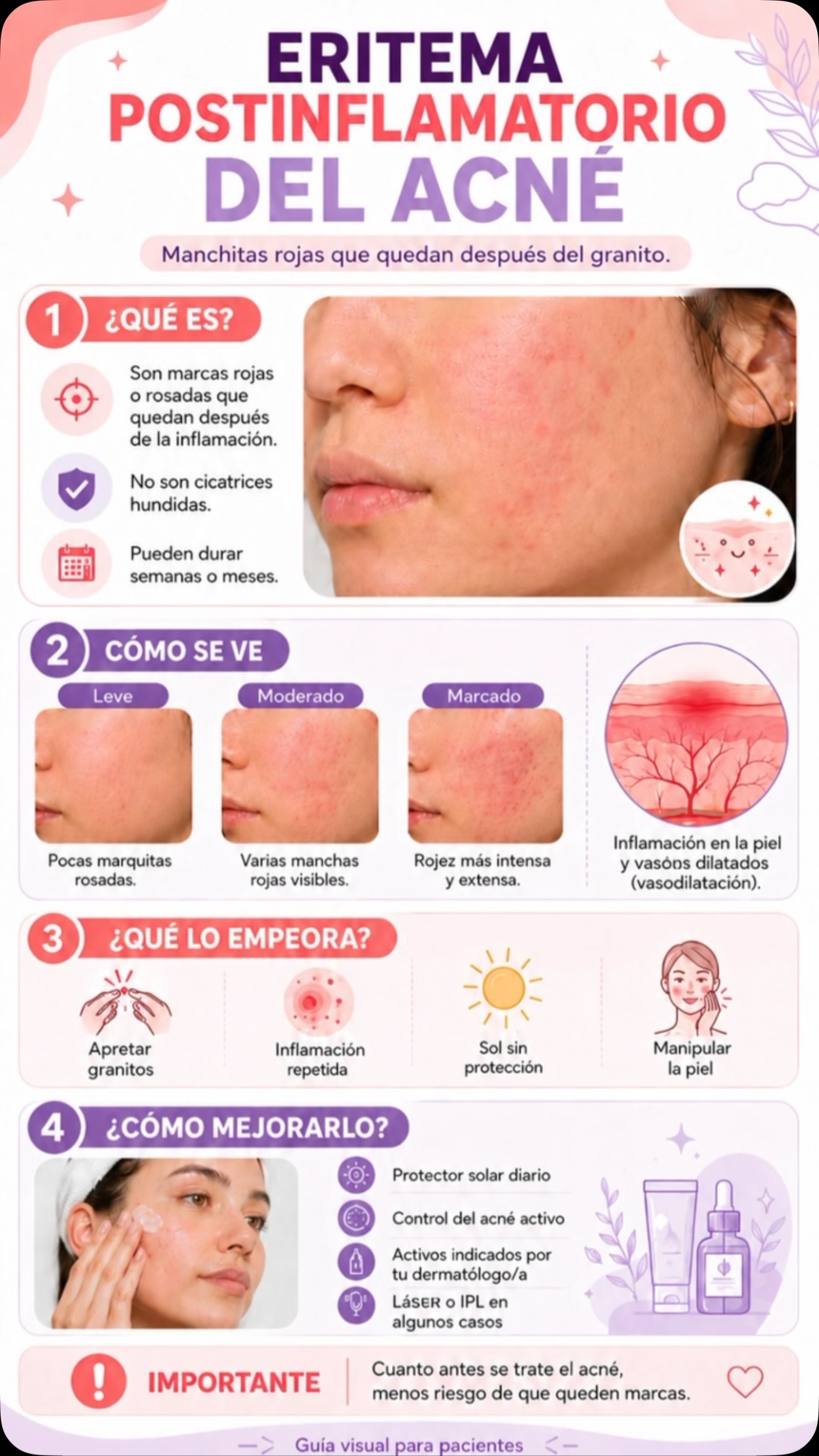 ¿Te quedaron manchitas rojas después del acné?
Eso se llama eritema postinflamatorio: son marcas rojizas o rosadas que aparecen después de la inflamación del granito.
No son cicatrices hundidas, pero pueden durar semanas o meses si no se tratan correctamente.
¿Qué puede empeorarlas?
Apretar granitos, inflamación repetida, sol sin protección y manipular la piel.
Con tratamiento adecuado, fotoprotección diaria y control del acné activo, se pueden mejorar.
📍 Doctora Buonsante Dermatología y Estética
📲 Turnos: 11 6666-2866
#Acne #MarcasDeAcne #EritemaPostinflamatorio #Dermatologia #PielSana CuidadoDeLaPiel IPL Dermatologa BuenosAires