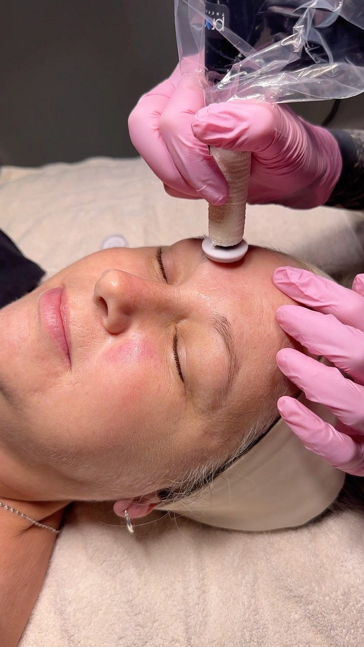 ✨ Procell Microchanneling ✨
Procell Microchanneling creates thousands of micro-channels that trigger your body’s natural repair response, building new collagen, tightening texture, fading scarring, and improving overall skin tone. All from your body’s own healing process doing exactly what it was designed to do.
This treatment was made for:
acne + acne scars
fine lines + wrinkle
texture + tone
pigmentation
loss of collagen + elasticity
If any of that sounds familiar! Hi, this is your new favorite treatment!
✨ All July: Buy a ProCell package of 3, get 1 free!
📲 Text us to book: 808-594-6440 or click the link in bio!