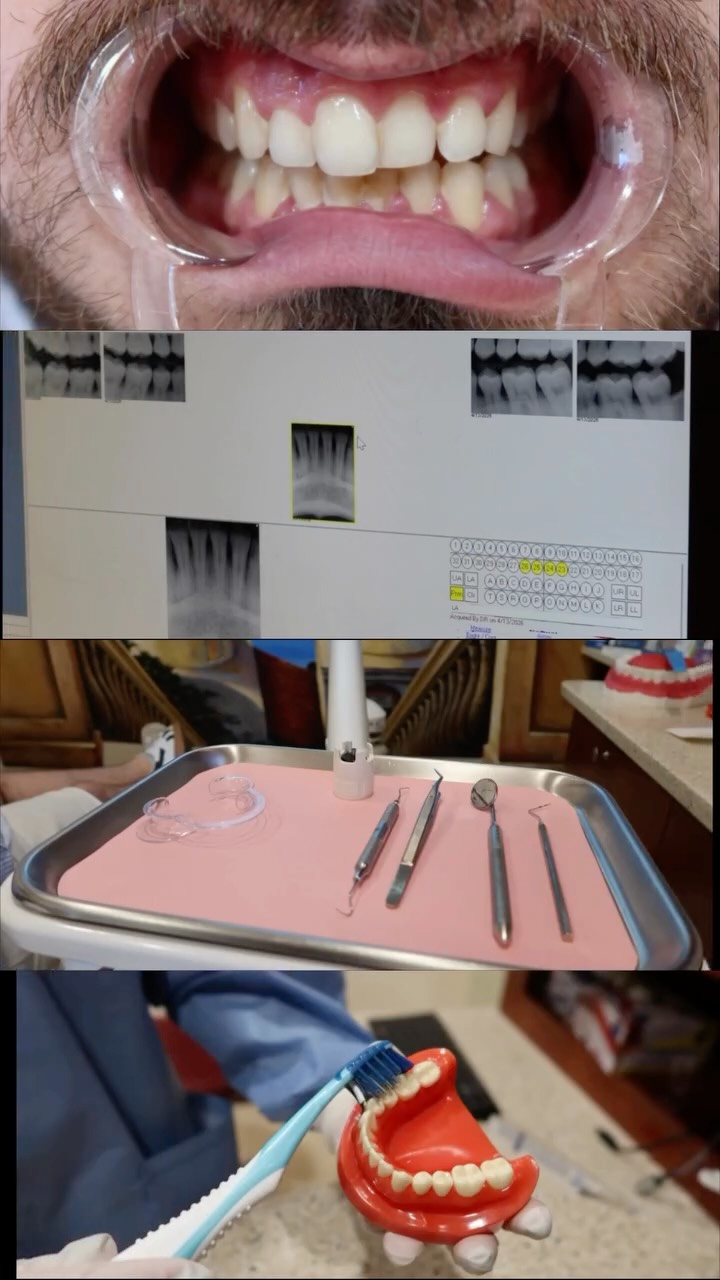 ¿Cuándo fue la última vez que te hiciste una limpieza dental profesional?
La placa y el sarro no solo afectan la apariencia de tu sonrisa. Cuando se acumulan, pueden provocar inflamación de las encías y, si no se tratan a tiempo, evolucionar hacia enfermedad periodontal, una de las principales causas de la pérdida de dientes en adultos.
En cada limpieza:
✔️ Evaluamos el estado de tus dientes y encías.
✔️ Eliminamos la placa y el sarro acumulados.
✔️ Te enseñamos la técnica correcta de cepillado para mantener una buena salud oral en casa.
La prevención siempre será más sencilla, menos invasiva y más económica que tratar un problema avanzado. Agenda tu limpieza y dale a tu sonrisa el cuidado que merece.
#oramasdentalcenter #dentalcleaning #healthygums #oralhealth #preventivedentistry