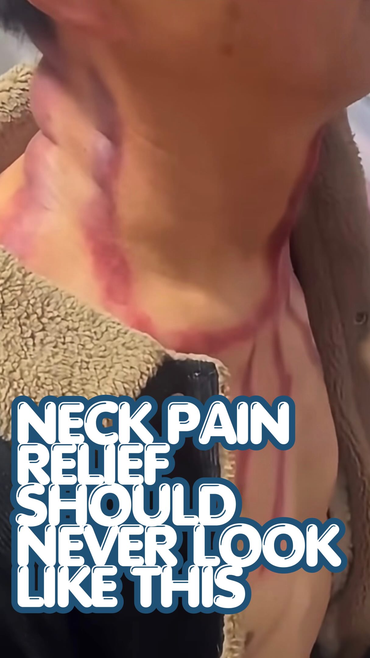 Not the crustacean-cosplay pinch parade you expected today eh? 🦀 This #whatthecupwednesday leaves your client looking like they lost a fight with a rose bush and call it manual therapy 🙄
⭕️
Petechiae are not a proxy for fascial glide, trigger point release, or “toxin mobilization.” They’re a bruise pattern with old school branding that really doesn’t do much at all. No need to be this aggressive, ever, with cupping or scraping or whatever the heck this is…
