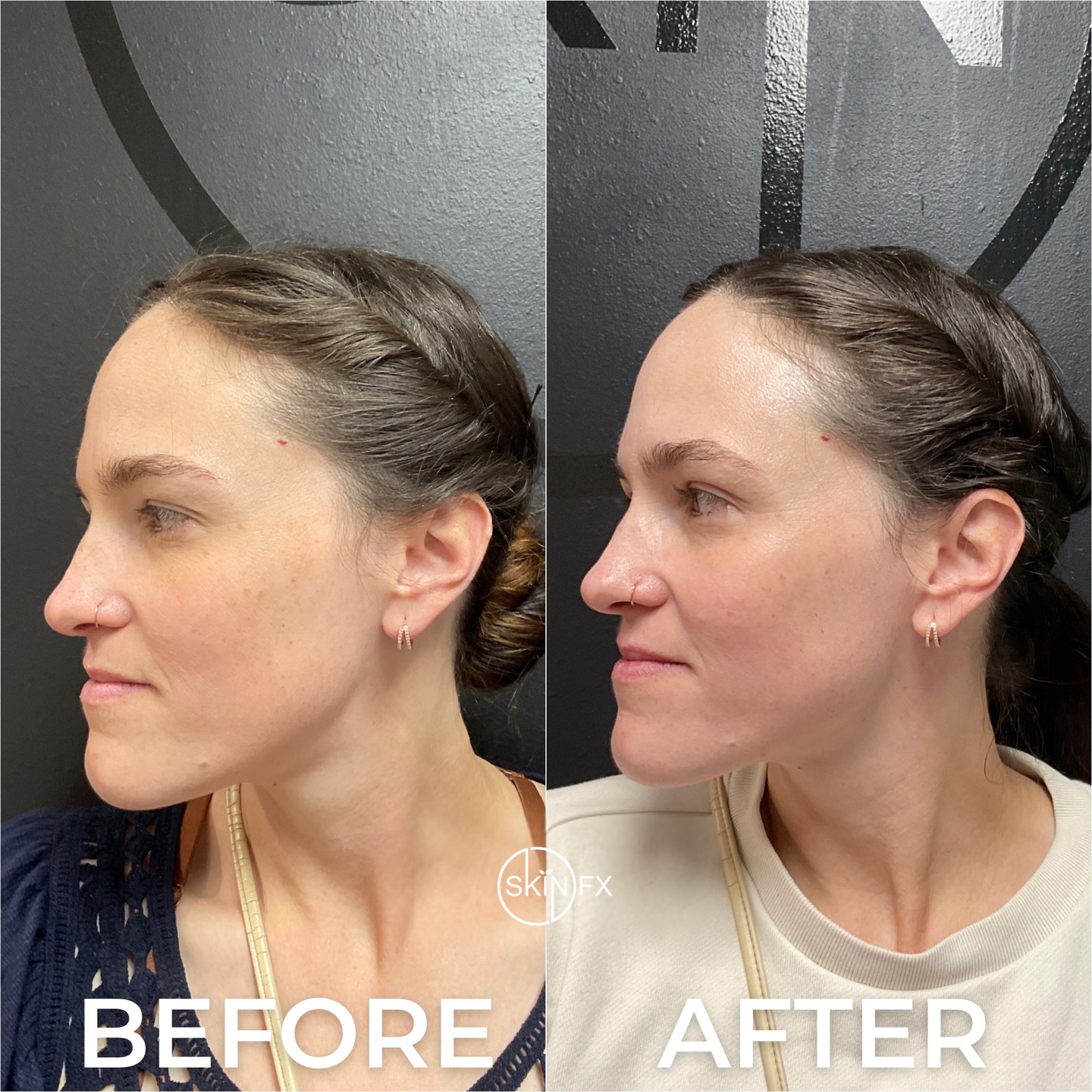 Give your skin a summer refresh with MOXI. Whether you’re looking to maintain your glow or improve tone and texture, MOXI is a great way to keep your skin looking its best.
Book your consultation today and let us help you achieve your healthiest skin yet.