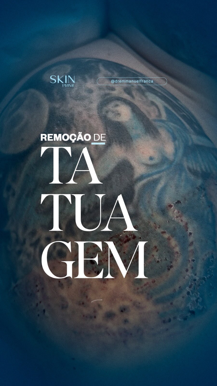 Remoção de tatuagem é uma procura bastante frequente. Se a tatuagem que você possui já não faz mais sentido, podemos te ajudar!
Dr Emmanuel França
Dermatologista
CRM 5999
RQE 636
📍Skin Prime - Riomar Trade Center - Torre 3 - Sala 1905
☎️ (81) 3036-4040