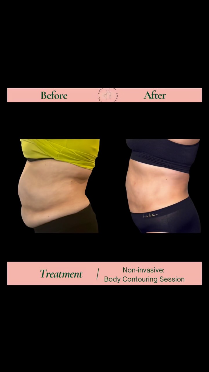 Curious about non-invasive body contouring?
During your consultation, we’ll discuss your goals and create a treatment plan tailored to you.
📍 Woodbridge, CT.
👉🏻Book your consultation today.
Results vary. A consultation is recommended to determine the best treatment plan for your individual goals.
#noninvasivebodycontouring#nonsurgicaltreatment#nonsurgicalbodysculpting#bodycontouring#ctspa