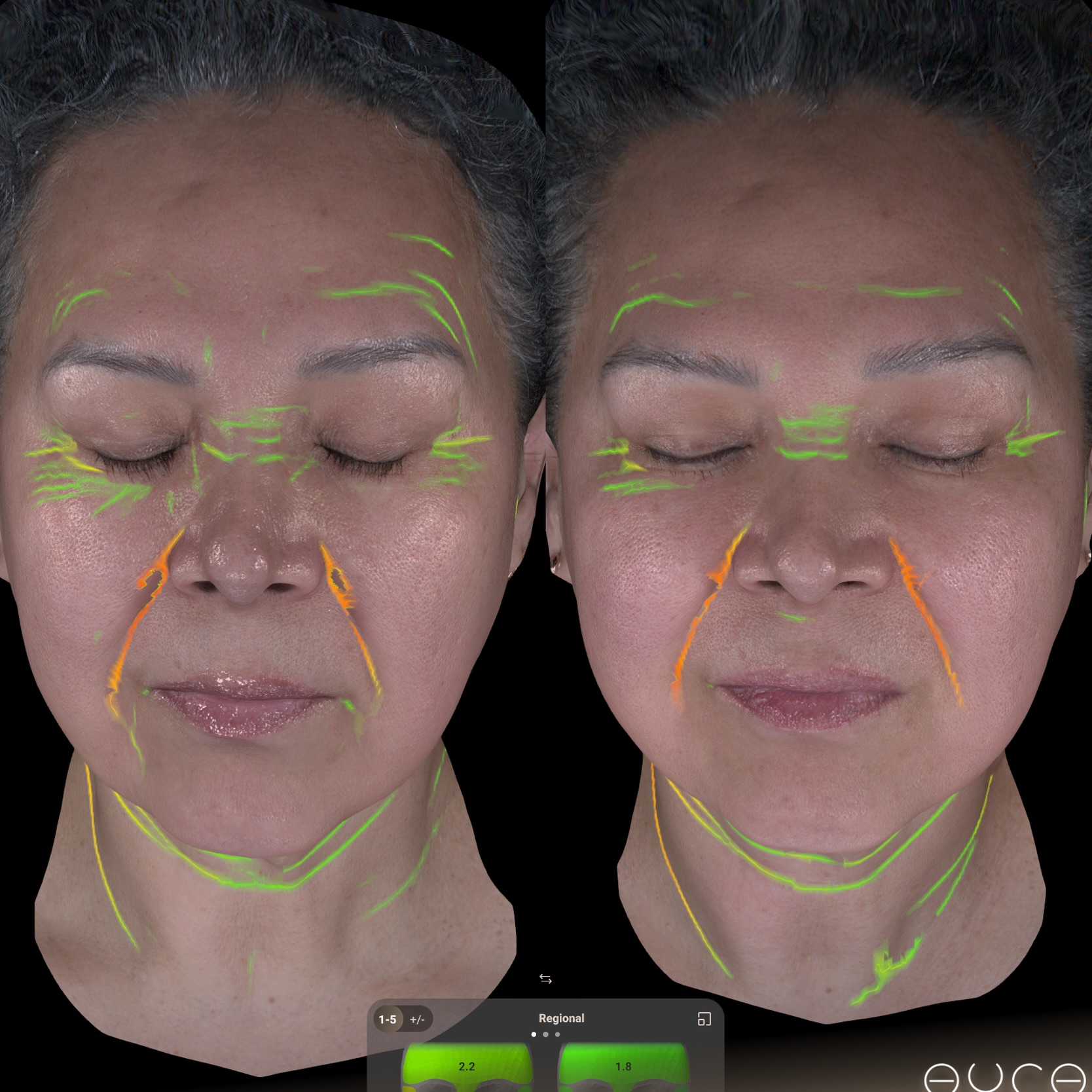 Reduction in fine lines and lower scores in all regions
*Free Face scan for all clients ✨
Before ➡️ Immediately after Esse Tight + Lift treatment - Full Face + Neck treatment
No pain, No downtime
Tightening 🤩🤩🤩
*Free Face scan for all clients ✨
Before ➡️ Immediately after Esse Tight + Lift treatment - Full Face + Neck treatment
No pain, No downtime
Our Aura Face + Skin Analysis showing how her skin is lifted after treatment
*Free Face scan for all clients ✨
Before ➡️ Immediately after Esse Tight + Lift treatment - Full Face + Neck treatment
No pain, No downtime
Tightening and of off skin on lid
*Free Face scan for all clients ✨
Before ➡️ Immediately after Esse Tight + Lift treatment - Full Face + Neck treatment
No pain, No downtime
