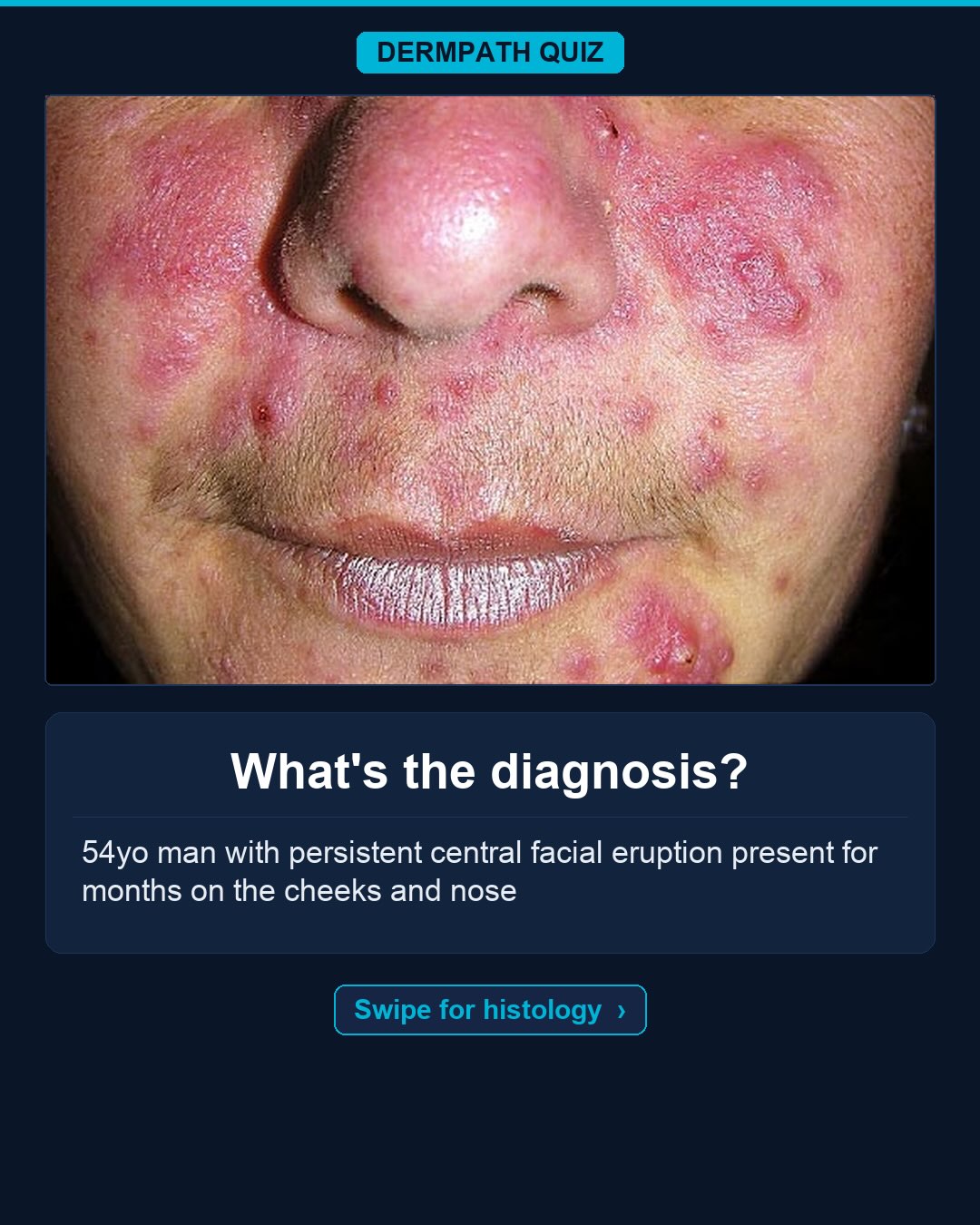 🔬 What’s the diagnosis?
The case: 54yo man with persistent central facial eruption present for months on the cheeks and nose.
Study the clinical photo and the histology, then make your call. Keep swiping for the diagnosis, the labeled slides, and the high-yield pearls.
Your diagnosis? Drop it in the comments before you swipe to the answer 👇
Save this for board review and tag someone who would nail it. Follow for new dermatopathology cases every week.