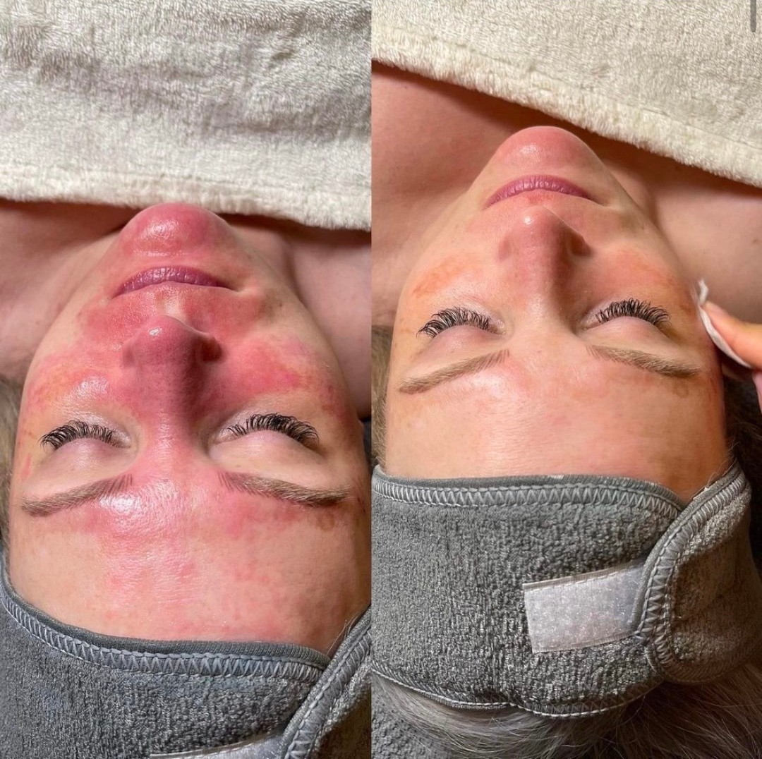 And that is the power of efficacy driven ingredients paired with the right therapist 💙👏
Incredible results by @uniquebeauty.brooke, just look at that glow ✨
When working with reactive, touch sensitive skin, thoughtful product selection and customisation make all the difference
Using Emergency Soothing Powder with Softening Gel as a calming mask, followed by a customised blend of Inflammation Inhibitor into Crucial Moisture, this treatment focused on reducing visible redness, supporting the barrier and restoring comfort 🙌
A perfect example of how professional expertise and targeted formulas can transform even the most sensitive skin
Because results are never one size fits all
#salonconnectau #salonconnect #professionalskincare #skintherapist #estheticianlife #treatmentroom #sensitiveskin #skinbarrier #customfacial #resultsdriven #skincareprofessionals #cliniccare #aesthetics #beautybusiness #clientresults