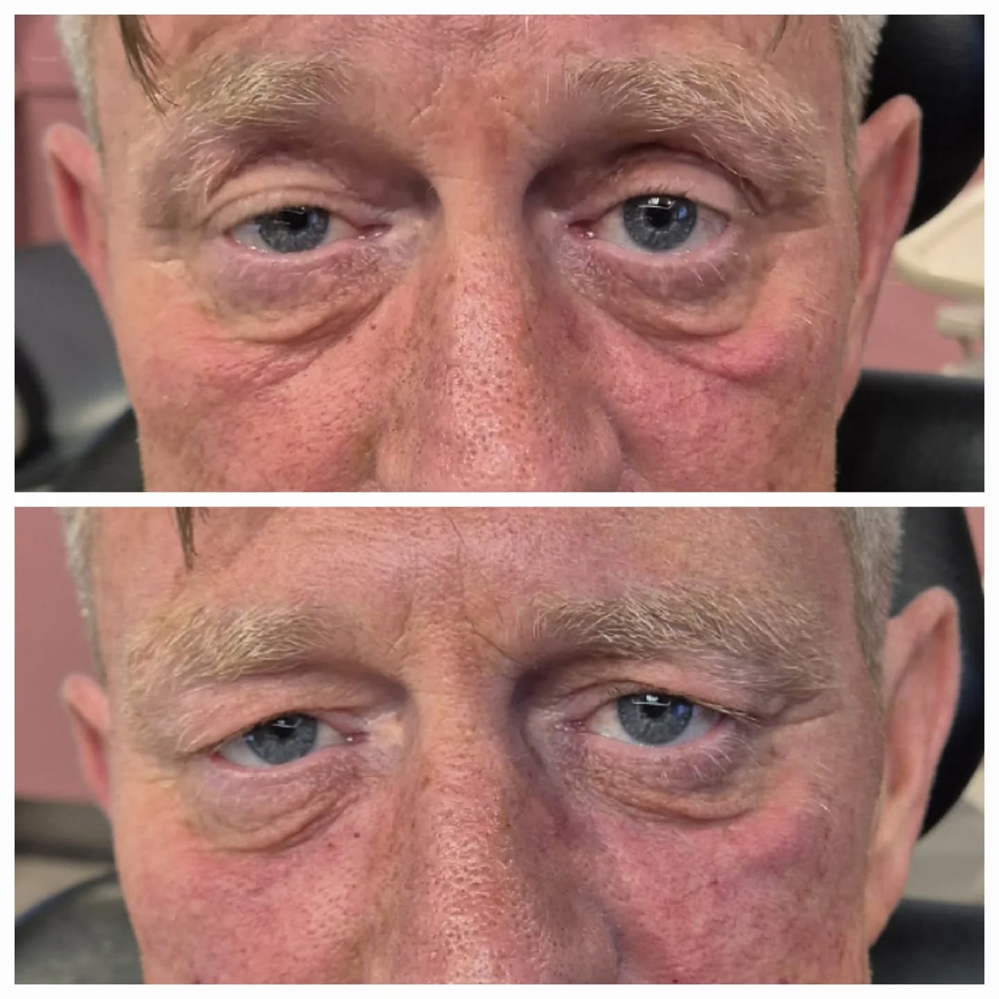 ✨ Under eye treatments: improvement over perfection ✨
The under-eye area is one of the most delicate and complex areas to treat, and something I always explain during consultations is that the goal isn’t always “perfectly smooth” under eyes.
Depending on factors such as: • Age
• Skin quality & thickness
• Genetics
• Volume loss
• Pigmentation
• Lifestyle factors
it isn’t always possible to completely erase every line, hollow, or shadow. But what we can do is create improvement, restore confidence, and help you look fresher and less tired 🤍
Every under eye concern is different, which is why the treatment plan needs to be personalised.
💉 Tear trough filler
Best suited for true hollowing or volume loss. It works by carefully replacing lost volume, reducing shadowing and creating a smoother transition between the lower eyelid and cheek.
🧬 Polynucleotides
Think of these as a skin quality treatment. They help stimulate repair, improve hydration, elasticity, fine lines and overall skin health by encouraging your own skin regeneration.
🩸 PRP (Platelet Rich Plasma)
Using growth factors from your own blood, PRP supports collagen production, skin repair and rejuvenation, helping improve texture and tired-looking skin.
✨ Microneedling
Creates controlled micro-injuries in the skin to stimulate collagen and elastin production, improving texture, fine lines and overall skin quality over time.
Sometimes the best results come from a combination approach rather than one single treatment.
Under-eye rejuvenation is a journey. Small, natural improvements can make a big difference to how refreshed you look.
If your under eyes are something that bother you, send me a message and we can get you booked in for a consultation to discuss the best option for you 🤍