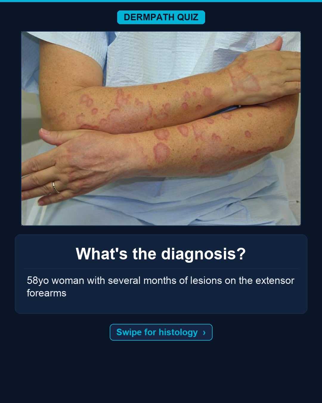 🔬 What’s the diagnosis?
The case: 58yo woman with several months of lesions on the extensor forearms.
Study the clinical photo and the histology, then make your call. Keep swiping for the diagnosis, the labeled slides, and the high-yield pearls.
Your diagnosis? Drop it in the comments before you swipe to the answer 👇
Save this for board review and tag someone who would nail it. Follow for a new dermatopathology case every day.