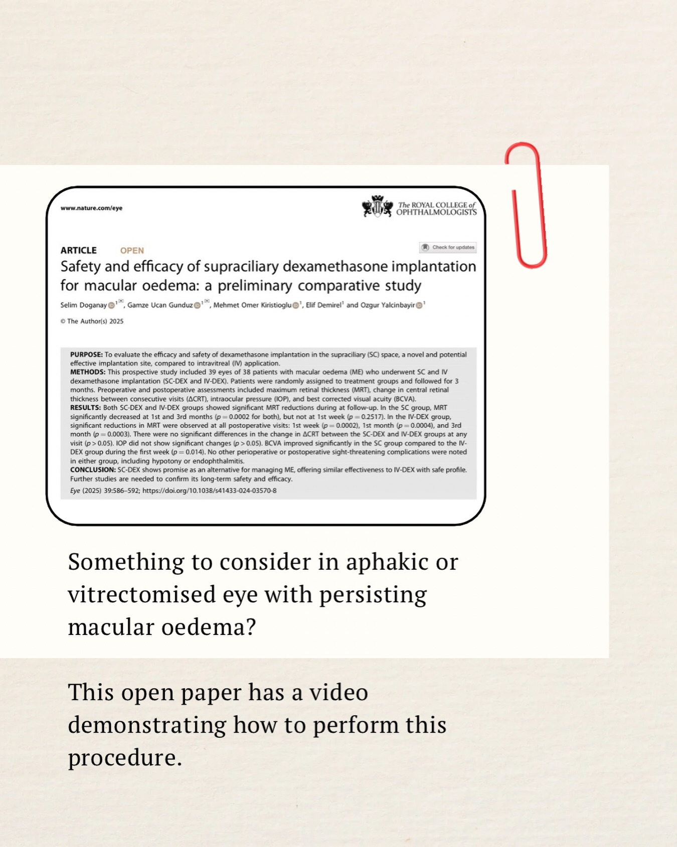 Suprachoroidal techniques are getting popular nowadays and this is one simple technique of injecting a dexamethasone implant into the supraciliary space for aphakic and vitrectomised eye with persisting macular oedema.
Full article available at: https://www.nature.com/articles/s41433-024-03570-8#MOESM1
#retinal #ozurdex #suprachoroidal #ophthalmology eyedoctorchng