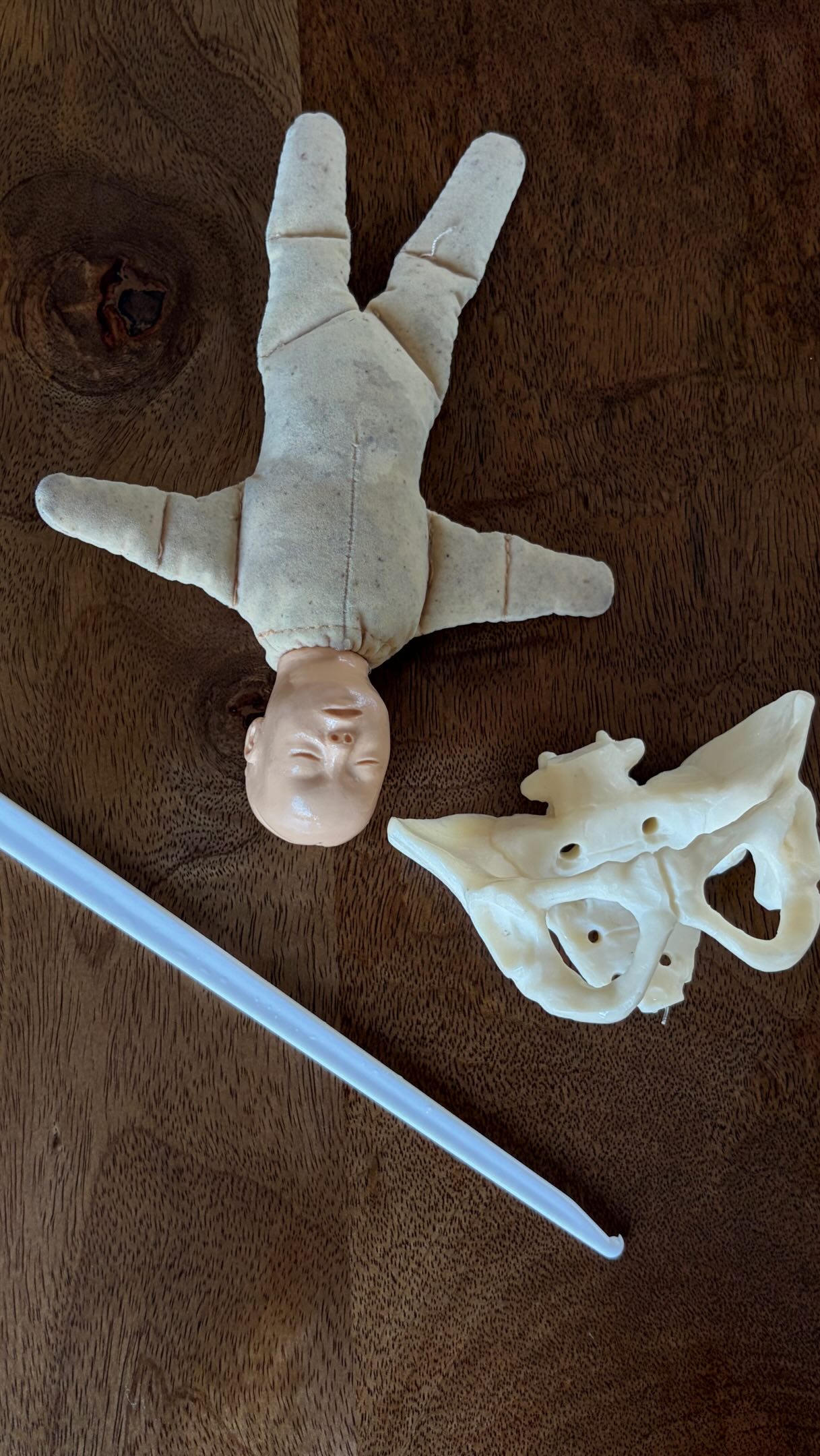 Kunstmatig breken van de vliezen 💦
Hier zie je de amniotoom (ook wel vliezenbreker genoemd).
Voordat we de vliezen breken, luisteren we eerst naar het hartje van de baby. Daarna doen we een inwendig onderzoek en brengen we de amniotoom voorzichtig in. Hiermee maken we een klein gaatje in de vliezen, waardoor het vruchtwater kan aflopen. Aan het einde zie je dat het hoofdje van de baby hierdoor vaak wat dieper komt te staan.
Bij een groot deel van de vrouwen breken de vliezen uiteindelijk spontaan tijdens de bevalling.Het kunstmatig breken van de vliezen kan een optie zijn wanneer de bevalling minder goed vordert. Door het breken van de vliezen kunnen extra hormonen vrijkomen, wat de weeën soms een boost geeft en de bevalling verder op gang kan helpen of kan versnellen. In dat geval bespreken we samen de mogelijkheden en kan het breken van de vliezen één van de opties zijn, meestal nadat we eerst andere dingen hebben geprobeerd.
Het breken van de vliezen word ook ingezet als onderdeel van een inleiding. 👶🏼🩵💗💦 #vruchtwater #vliezenbreken #verloskundigenpraktijk #bevalling