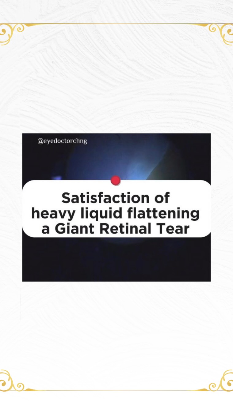 One of the satisfying feeling of a VR surgeon when repairing a retinal detachment surgery.
This is a video courtesy of @veleyesaris on a taco shaped giant retinal tear (GRT) flattened with perfluorocarbon liquid (PFCL) or heavy liquid.
#retinaldetachmentsurgery #giantretinaltear #vitrectomy #ophthalmology #eyedoctorchng