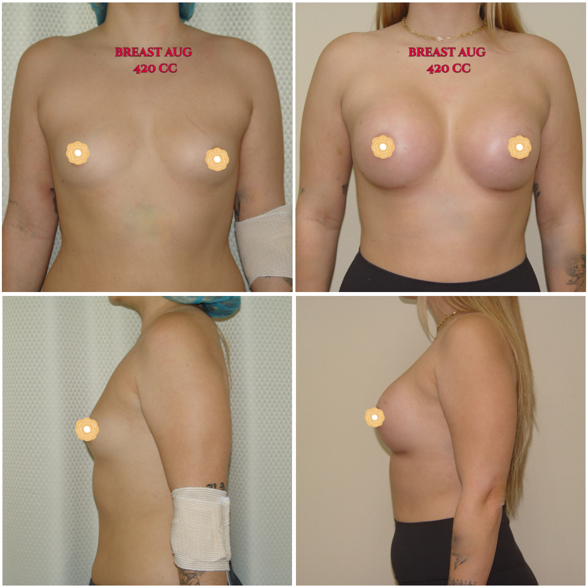 Breast aug with 420 cc silicone gel implants in a young lady in her 20's. She is athletic and didn't want to go overly large.