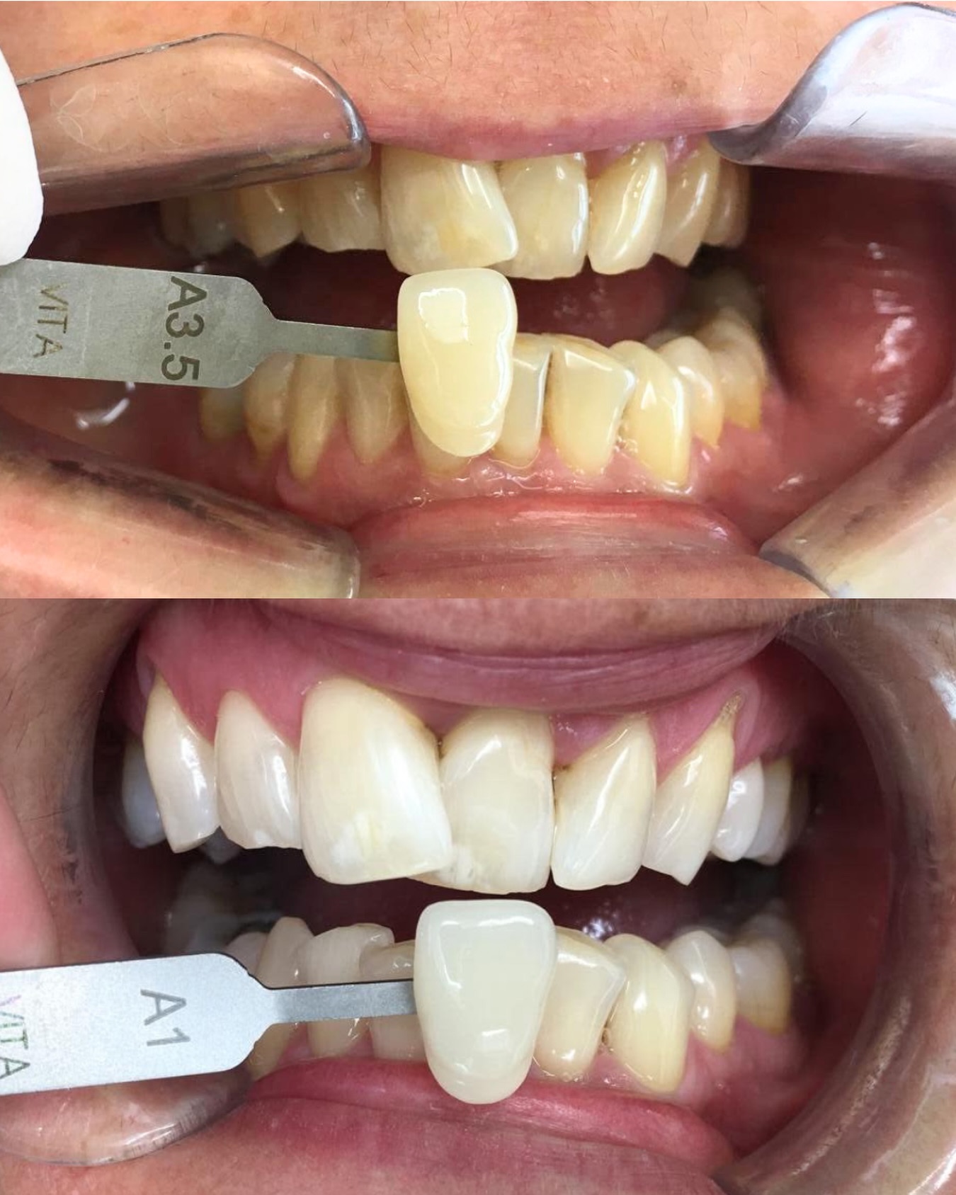 Passer de A3.5 à A1, notre patient a retrouvé un sourire plus éclatant grâce à un éclaircissement réalisé au cabinet Rodde & Associés.
Résultat : un sourire plus naturel et harmonieux. Et si c’était à votre tour ?
.
.
.
#roddeassocies #AvantApres #EclaircissementDentaire #BlanchimentDentaire #Sourire