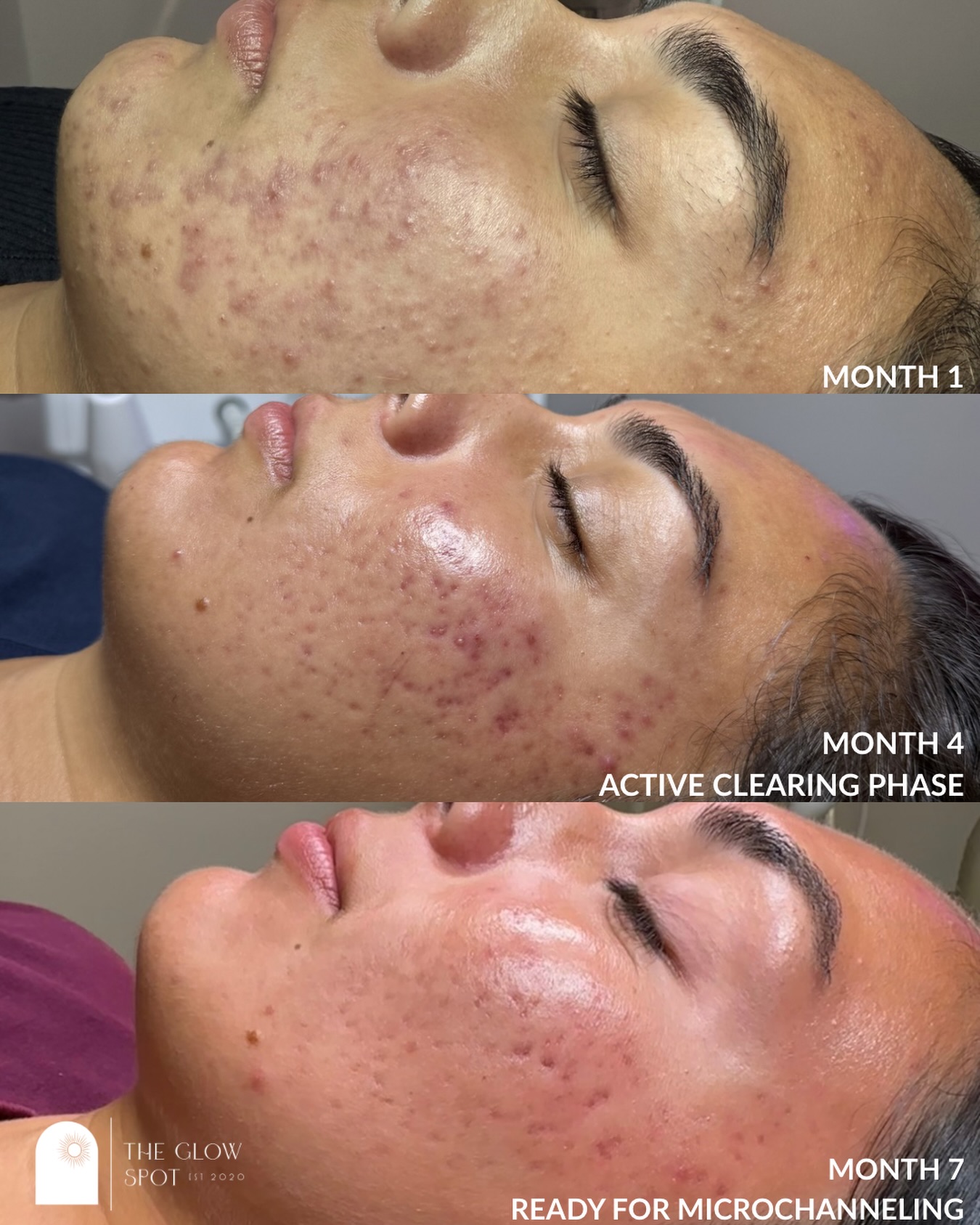 POV: you didn’t give up on your skin 🥹✨
7 months, 3 phases, and so so much patience!!
Not every acne journey moves fast, and hers took time, which is totally okay. We both did our part of the work: acne peels + enzymes, high frequency, extractions, biweekly treatments (then spacing out to monthly as her skin caught up), daily home care plus some lifestyle tweaks along the way.
Now we’re moving into Procell Microchanneling to start working on the PIE and scarring left behind. Different phases, same commitment!!
If your skin isn’t “there” yet, it doesn’t mean it’s not working. Everyone’s timeline looks different, and consistency always wins in the end. 🫶
Skin revision by Hailey