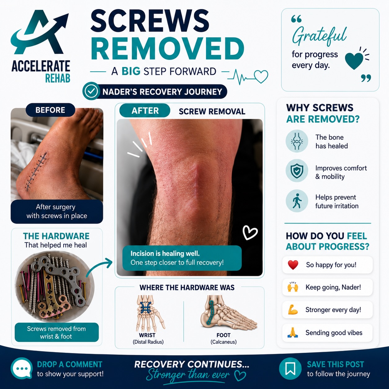 🔩✨ A huge milestone in Nader’s recovery journey!
After months of perseverance, rehab, and determination, Nader has officially had the screws and hardware removed from his ankle, wrist and lower back 🙌
This marks another important step forward following the serious injuries he sustained. While the journey isn’t over yet, removing the hardware is a positive sign that healing continues and we can now focus on progressing strength, mobility and function 💪
👏 Drop a comment below to show Nader some support as he enters the next phase of rehab!
#AccelerateRehab #RecoveryJourney #physiotherapyrehab