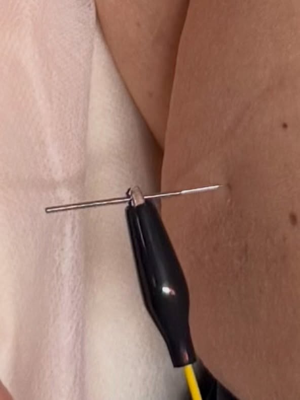 Ever wonder how electroacupuncture works? ⚡️ Tiny alligator clips are gently attached to acupuncture needles, delivering a mild electrical pulse that targets specific muscle groups. This helps stimulate muscles, improve circulation, reduce pain, calm inflammation, and support faster recovery—all while enhancing the benefits of traditional acupuncture.
Whether you’re recovering from an injury, managing chronic pain, or looking to improve athletic performance, electroacupuncture is a safe and effective treatment option.
📍Moment Wellness Acupuncture & Herbal Medicine | Conifer, CO
#ElectroAcupuncture #Acupuncture #ConiferCO #PainRelief #MuscleRecovery