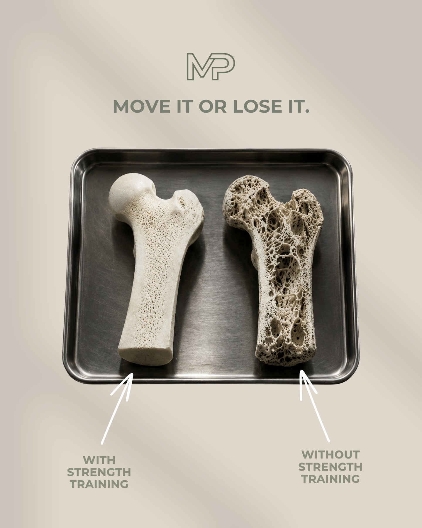 🦴 Your bones are living tissue, not just solid blocks of calcium.
They're constantly adapting and rebuilding in response to the demands you place on them. The image on the left shows healthy bone architecture, while the image on the right highlights how bone density and strength can decline over time without the right stimulus.
Bone health is influenced by many factors, including:
• Mechanical loading
• Nutrition
• Hormones
• Recovery
• Physical activity
One of the most important drivers of healthy bones is resistance training. When your bones are exposed to appropriately challenging loads, they respond by becoming stronger and more resilient. Research shows that higher intensity strength training can play an important role in maintaining or improving bone density over time.
Strength training isn't just about building muscle. It's about reducing injury risk, supporting healthy ageing and maintaining the ability to move confidently throughout life.
Your bones adapt to how you use them. Give them a reason to stay strong.