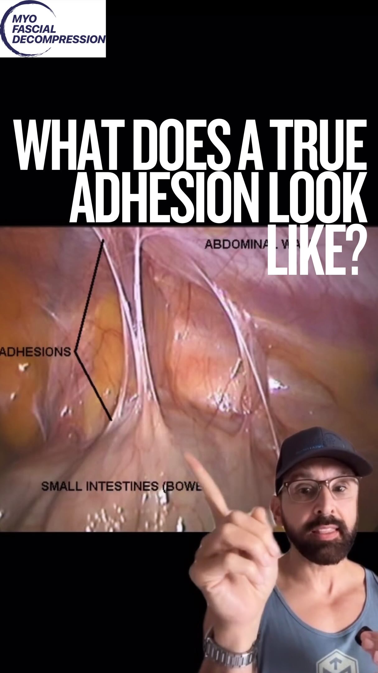 🛑 STOP trying to “break up” adhesions. You can’t.
If your patient has true fibrosis (membrane proteins adherence), your hands or tools aren’t going to tear it apart. You’d need a scalpel for that. 🔪
So, what are we actually doing when tissue feels “stuck” and then suddenly releases?
We are changing viscoelasticity, not structure. 🌊
It’s all about Hyaluronan and Lubricin. These molecules are the body’s natural lubricant that lives between your fascial layers. When you get stiff, they may get sticky (like cold honey).
Manual therapy + movement adds heat and shear force, turning that sticky HA back into a fluid lubricant. We aren’t breaking things; we are hydrating them so they can SLIDE. ⛸️
Watch the end of the video for the visual on why you need glide, not grit.
👇 How do you explain this to your clients/athletes? Drop it below.
#fascia #manualtherapy #mythbusting #adhesions