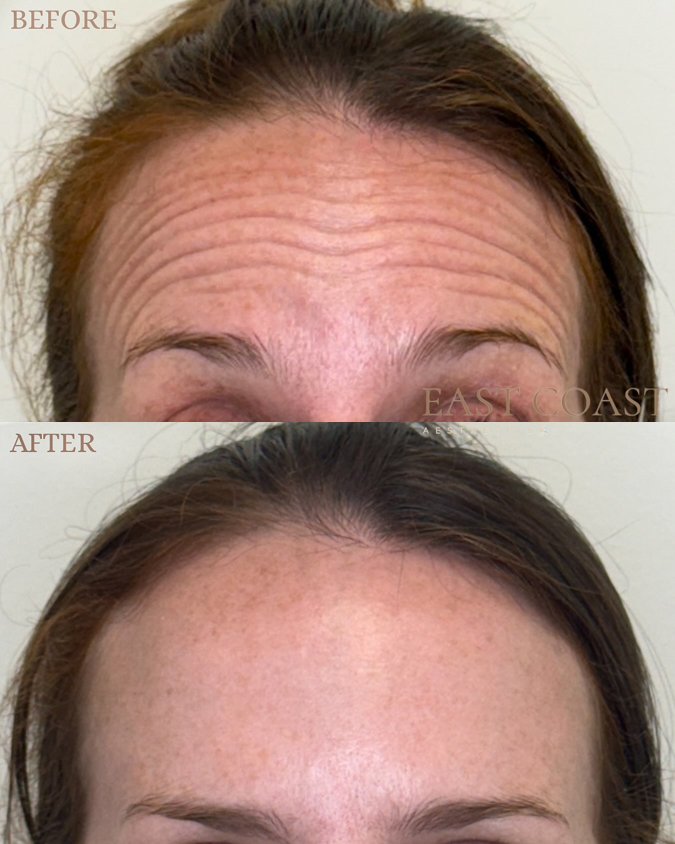 This patient received Botox to soften forehead lines and create a smoother, more refreshed appearance. Natural-looking results that still allow for beautiful facial expression 💉✨
#eastcoastaesthetics #medspa #medicalaesthetics #botox #beforeandafter