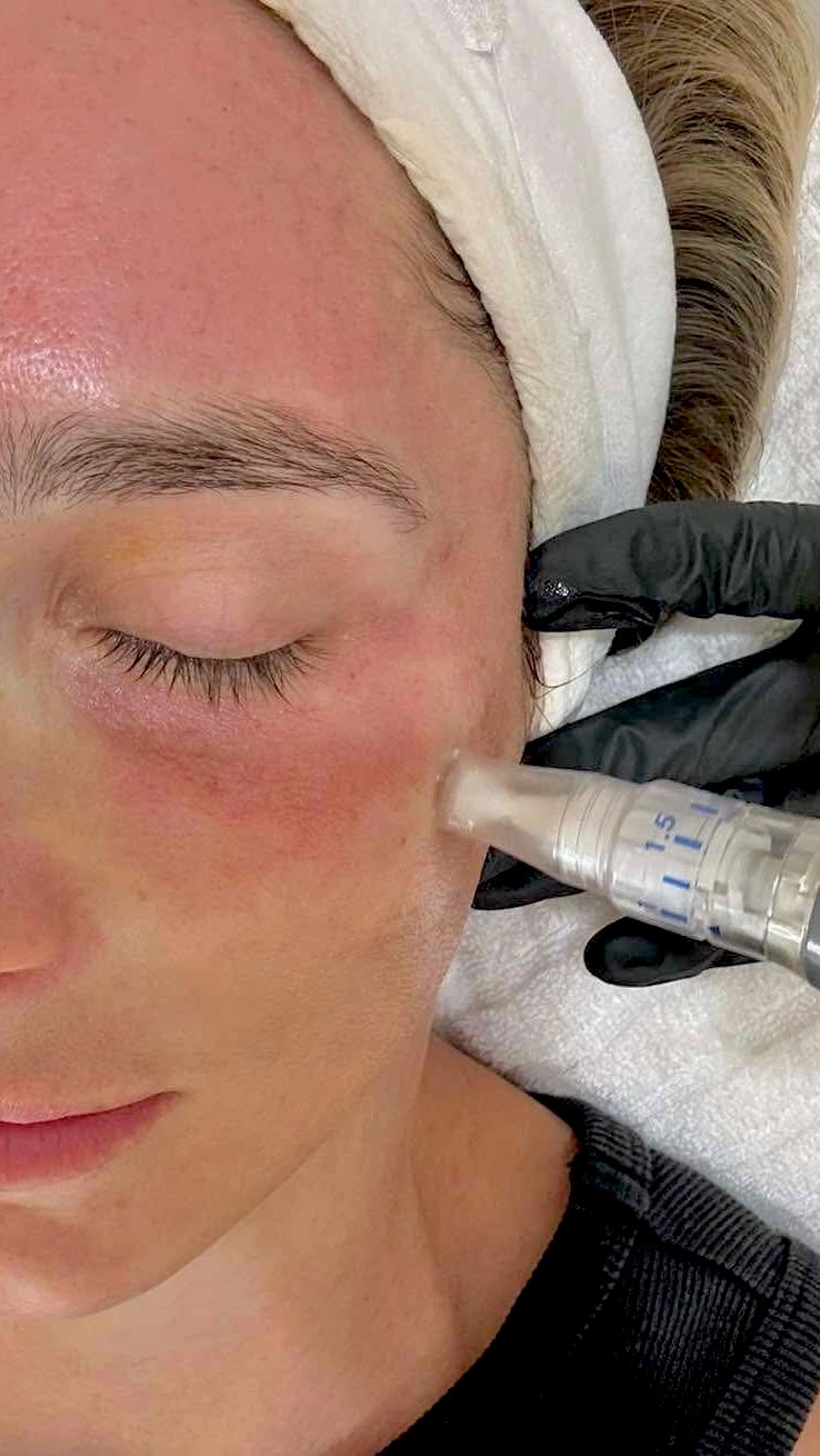 Story time… You’ve heard of skin needling but what actually happens during the treatment and how will you look after the treatment?
Come behind the scenes as we show you each step from prep to final glow!
*Tiny controlled micro channels are created
*Collagen and elastin are stimulated
*Product absorption increased
*Strengthens skin barrier
*Improves fine lines, texture, scarring, pigmentation and overall skin health
Got questions? Pop them in the comments below or book in for a consultation with our Skin Therapist
#skinpen #microneedling #skinneedling #collageninductiontherapy #brisbaneskinclinic