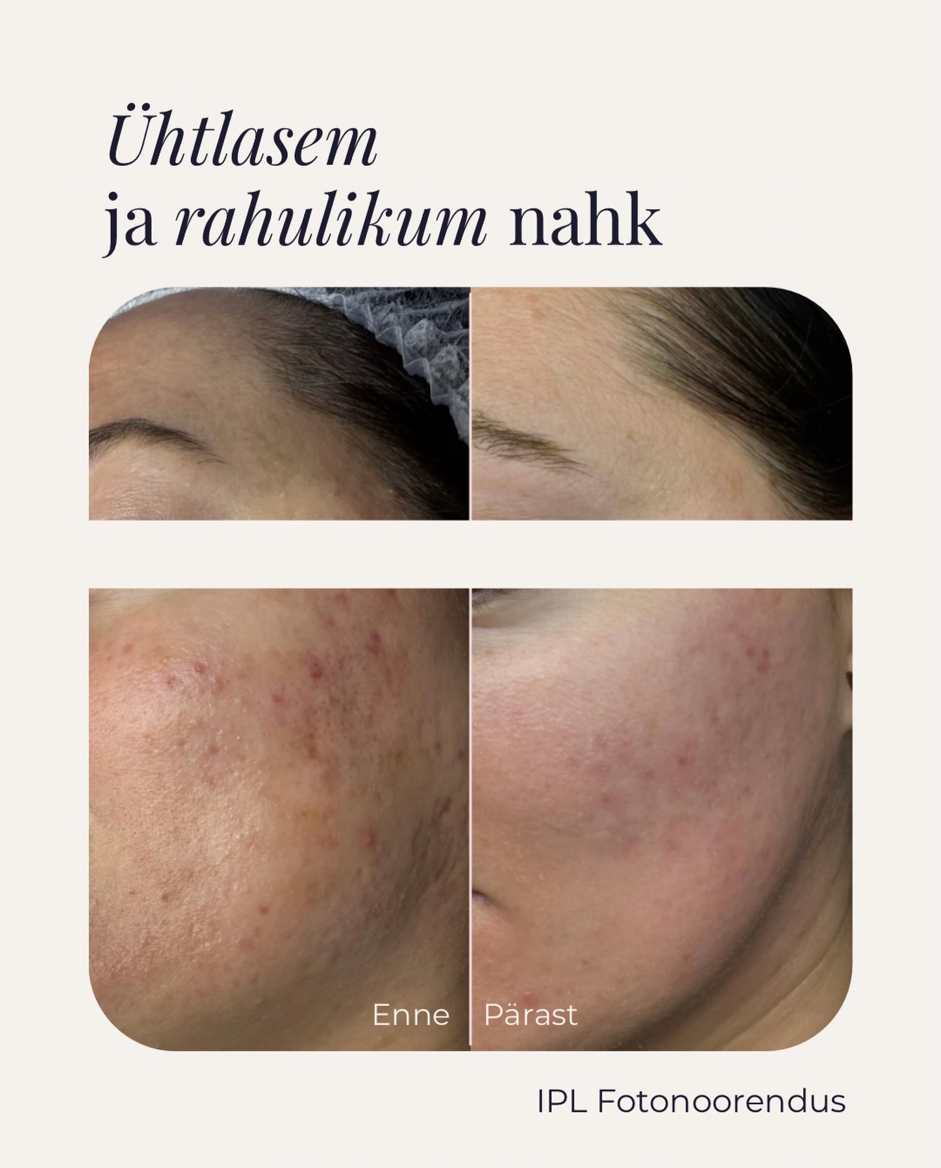 Ühtlasem ja rahulikum nahk ✨
Punetus, pindmised veresooned, ebaühtlane jume ja aknejärgsed jäljed võivad muuta naha väsinuks ning ebaühtlaseks.
IPL fotonoorendus aitab vähendada punetust ja pigmendimuutusi, ühtlustada nahatooni ning parandada naha üldist kvaliteeti. Tulemuseks on rahulikum, kirkam ja värskema ilmega nahk.
Pildil on näha muutus pärast IPL-ravi – nahatoon on ühtlasem ning punetus märgatavalt vähenenud.
✨ Sobib hästi, kui soovid leevendada:
- rosaatseast tingitud punetust
- pindmisi veresooni
- päikesekahjustusi ja pigmentatsiooni
- aknejärgseid punetavaid jälgi
- ebaühtlast nahatooni
Iga raviplaan koostatakse individuaalselt, lähtudes naha seisundist ja soovitud tulemusest.
📍 Medicina Kliinik, Tartu
Broneerimiseks kirjuta meile või broneeri aeg meie kodulehel.
#medicinakliinik #ipl #iplfotonoorendus #rosaatsea #punetus