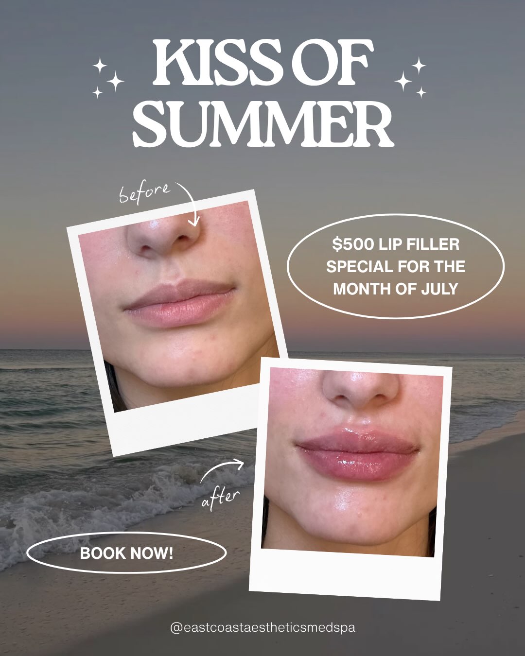 Kiss summer with lips you’ll love all season long 💋
For the month of July, enjoy our Lip Filler Special for $500! Whether you’re looking for subtle hydration, enhanced shape, or a fuller pout, we’ll create results that complement your natural features.
✨ Limited-time offer—book your appointment before July ends!
📍East Coast Aesthetics Medspa
📞703-493-0417
#eastcoastaesthetics #medspa #lipfiller #medicalaesthetics #filler